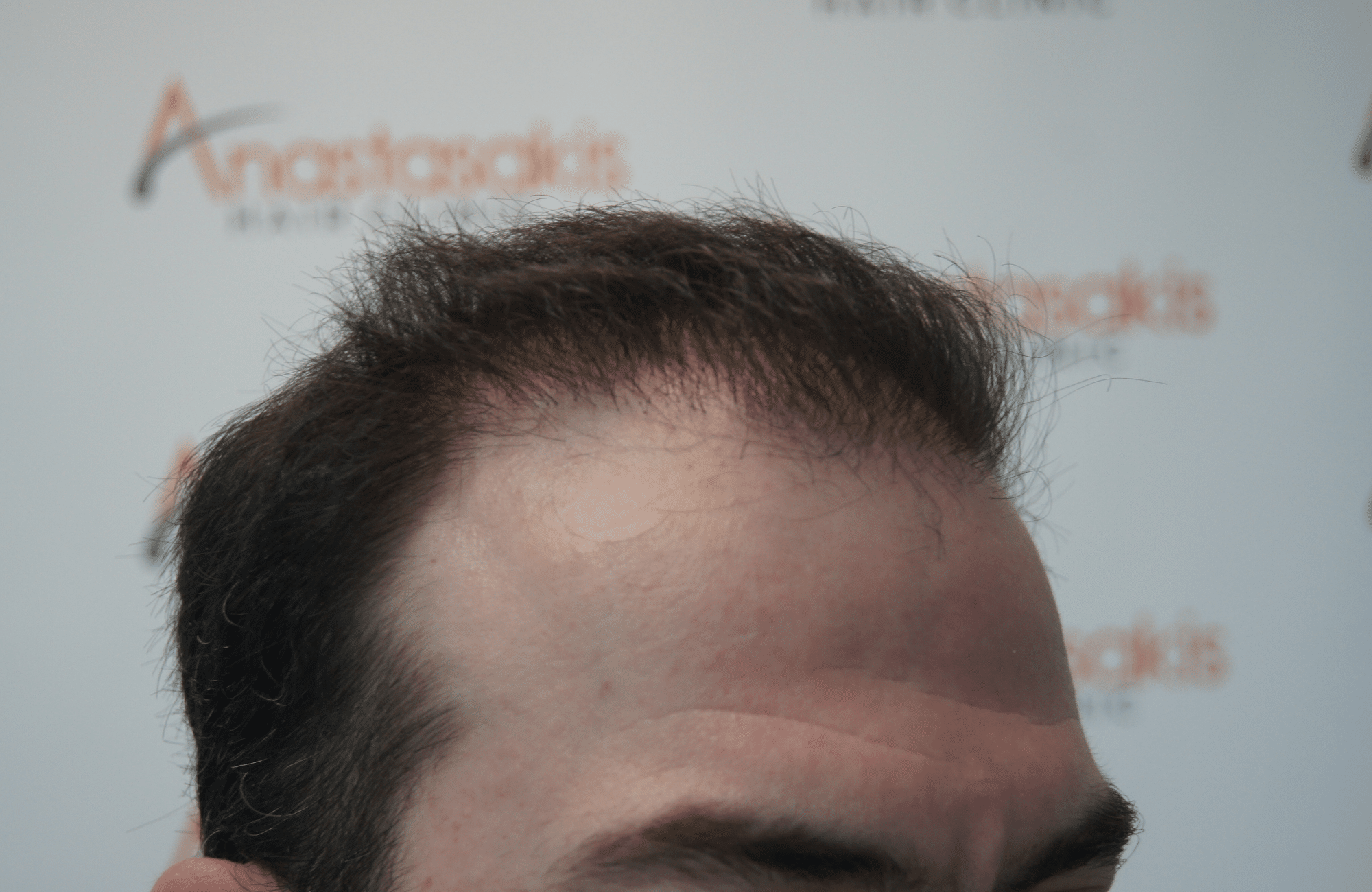 hair transplant with 2500 fus fue before - side1
