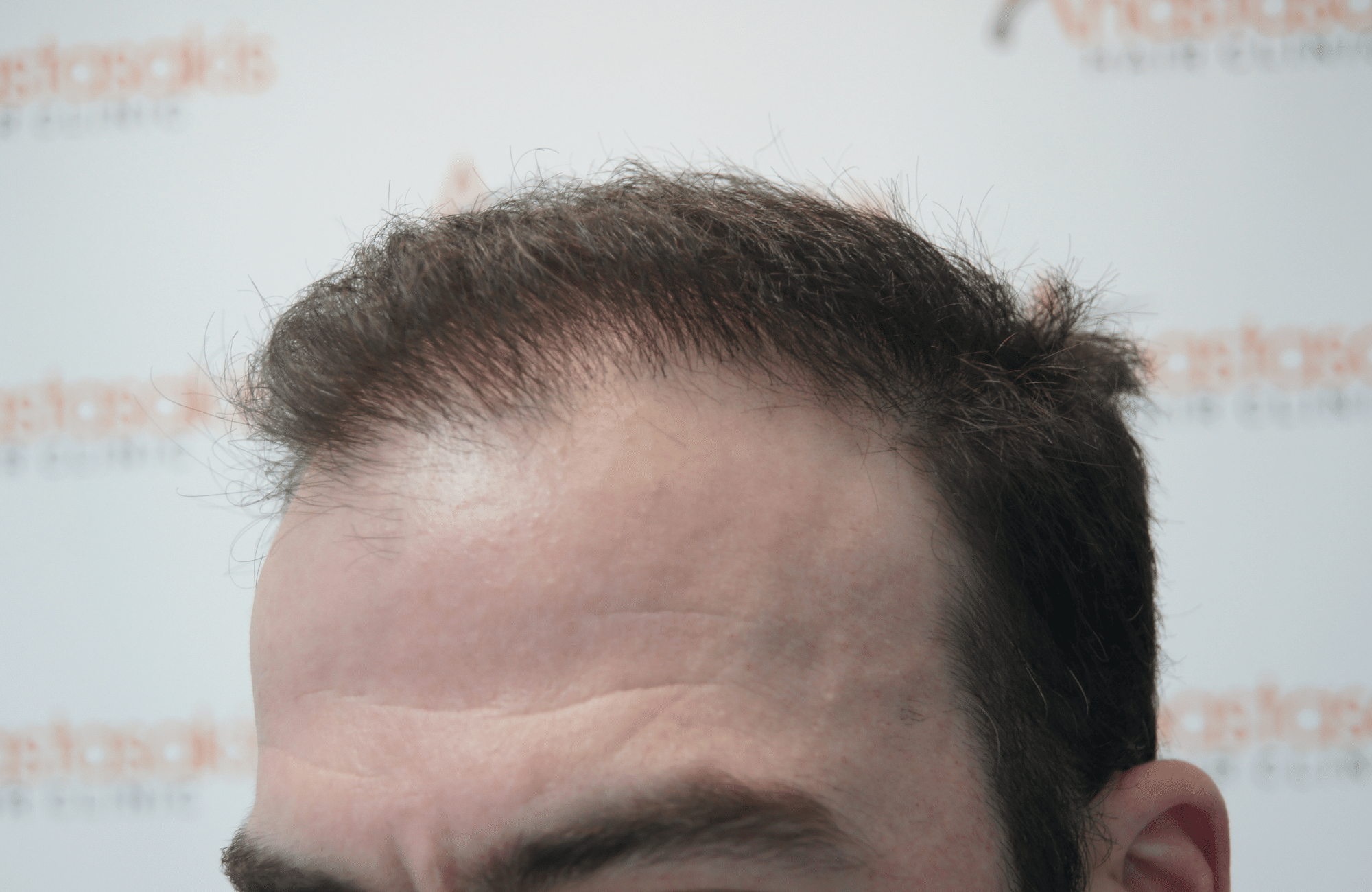hair transplant with 2500 fus fue before - side2