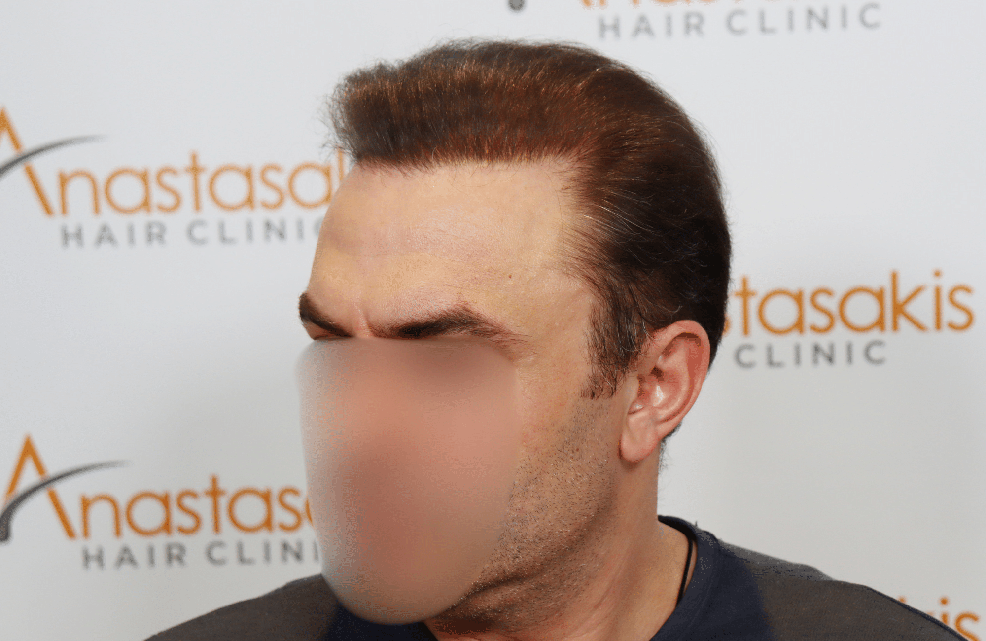 hair transplant result 5200 fus