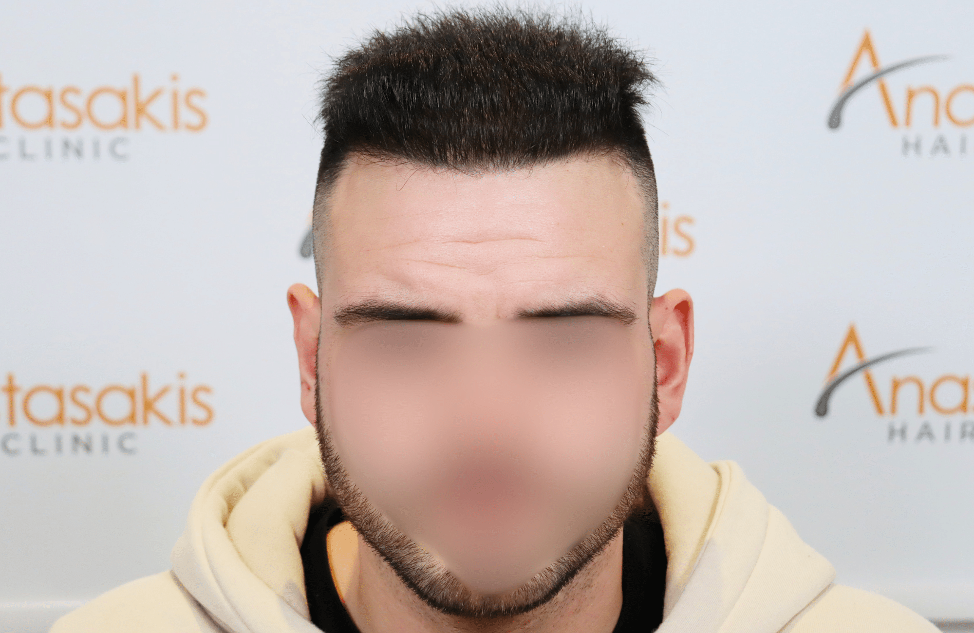 hair transplant result 2500 fus
