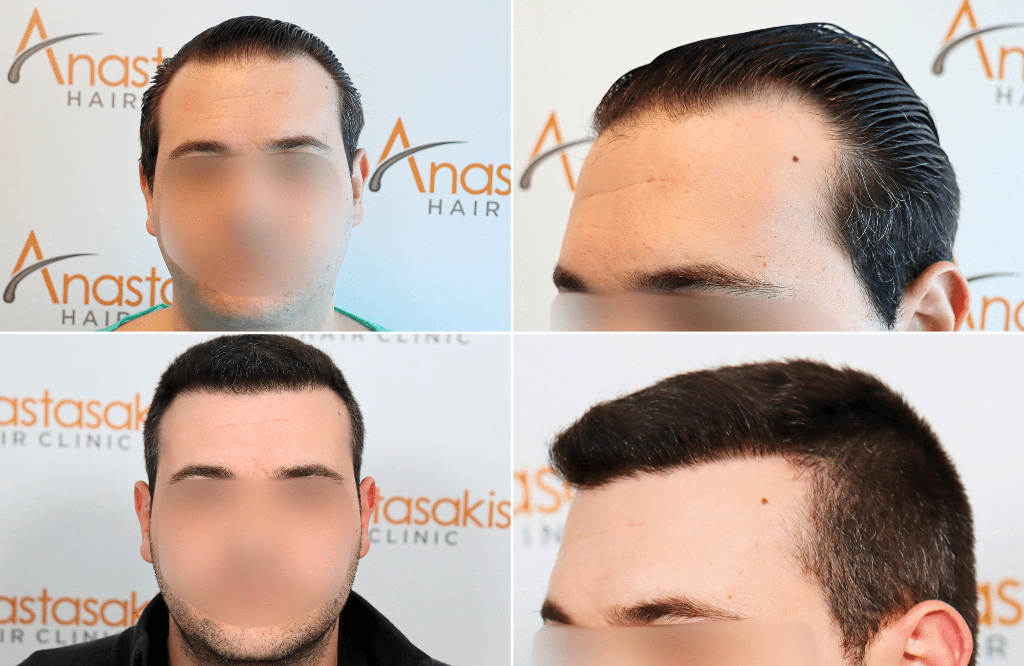 https://www.anastasakishairclinic.gr/portfolio/apotelesma-metamosxefsis-mallion-anastasakis-hair-clinic-63/
