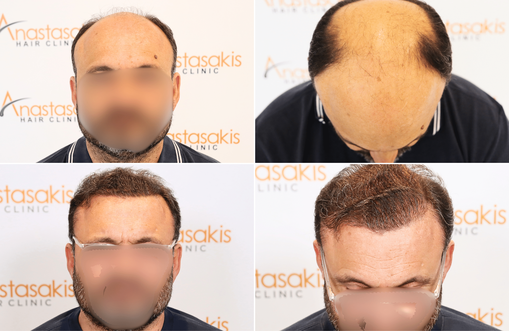 https://www.anastasakishairclinic.gr/portfolio/apotelesma-metamosxefsis-mallion-anastasakis-hair-clinic-244/