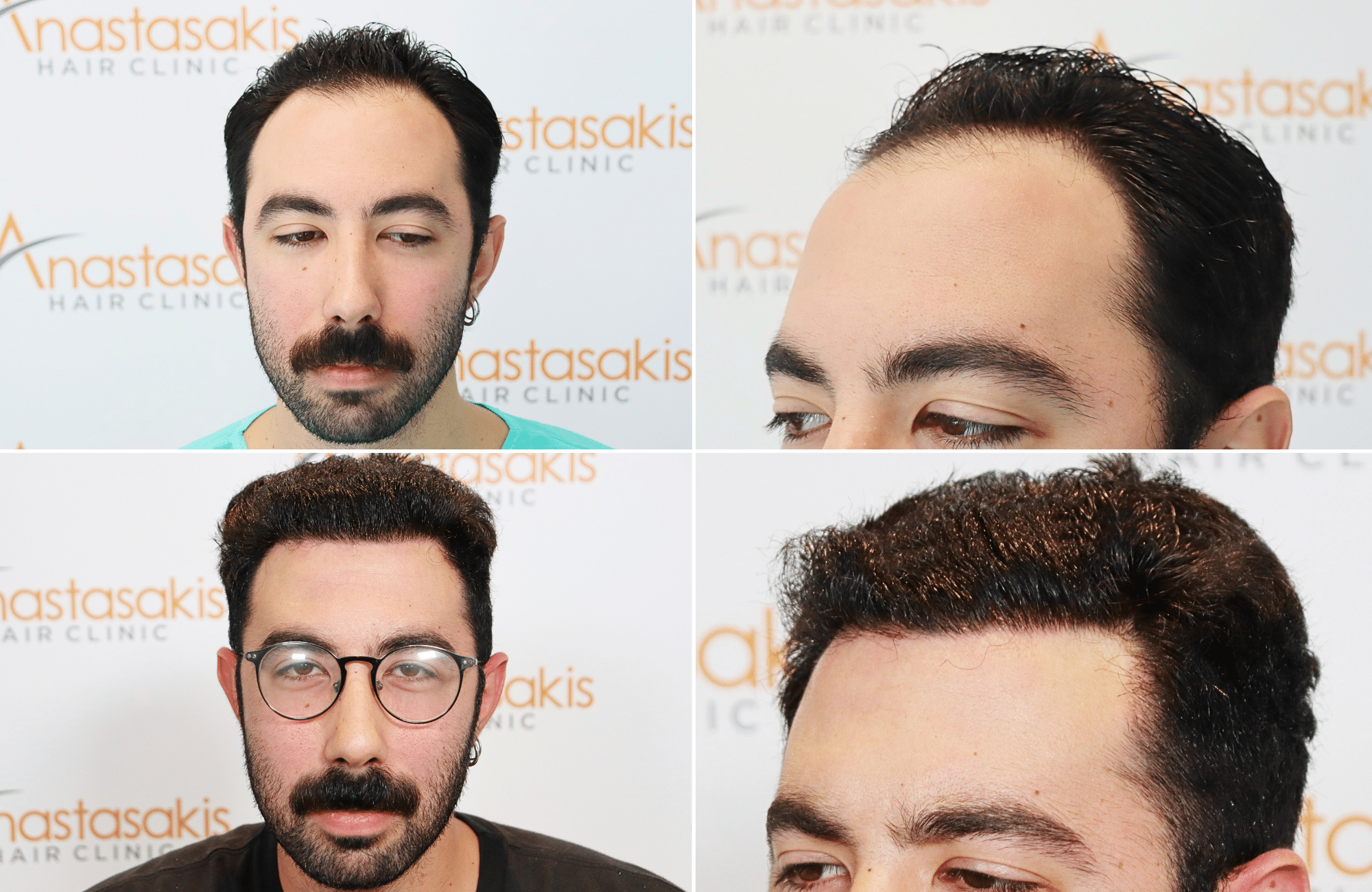 https://www.anastasakishairclinic.gr/portfolio/apotelesma-metamosxefsis-mallion-anastasakis-hair-clinic-98/
