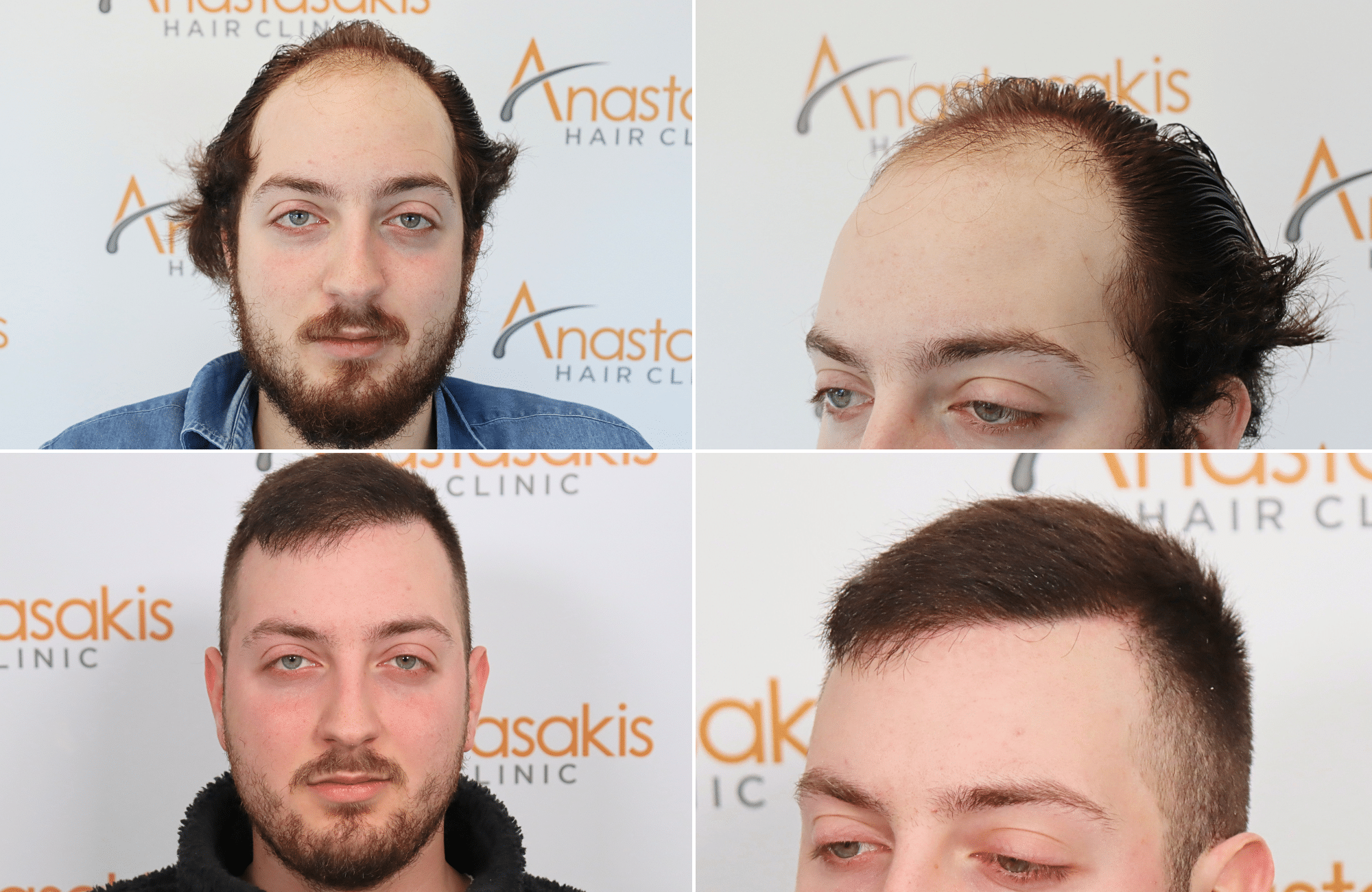 https://www.anastasakishairclinic.gr/portfolio/apotelesma-metamosxefsis-mallion-anastasakis-hair-clinic-119/