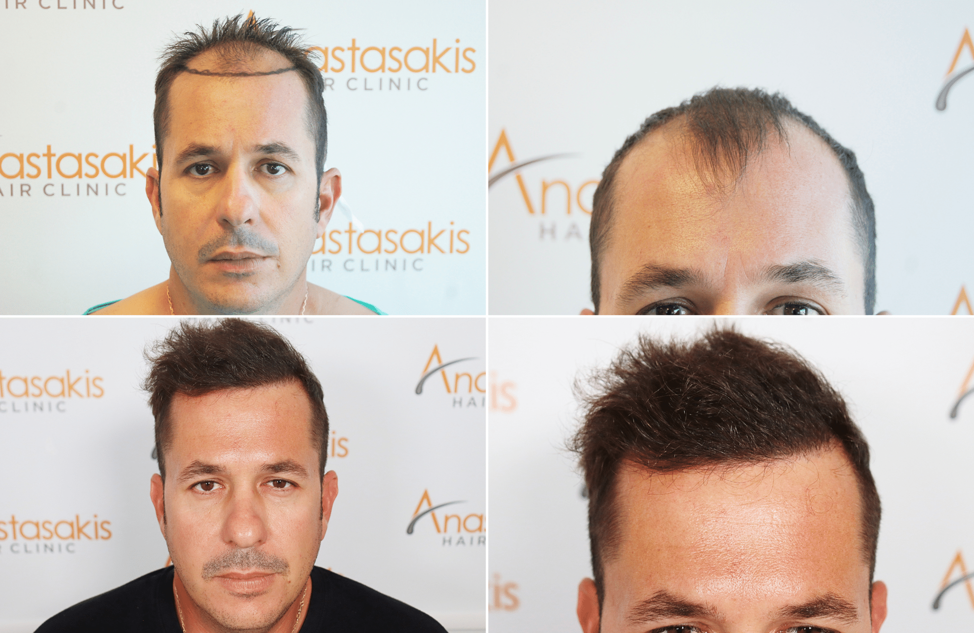 hair transplant result 2600 fus