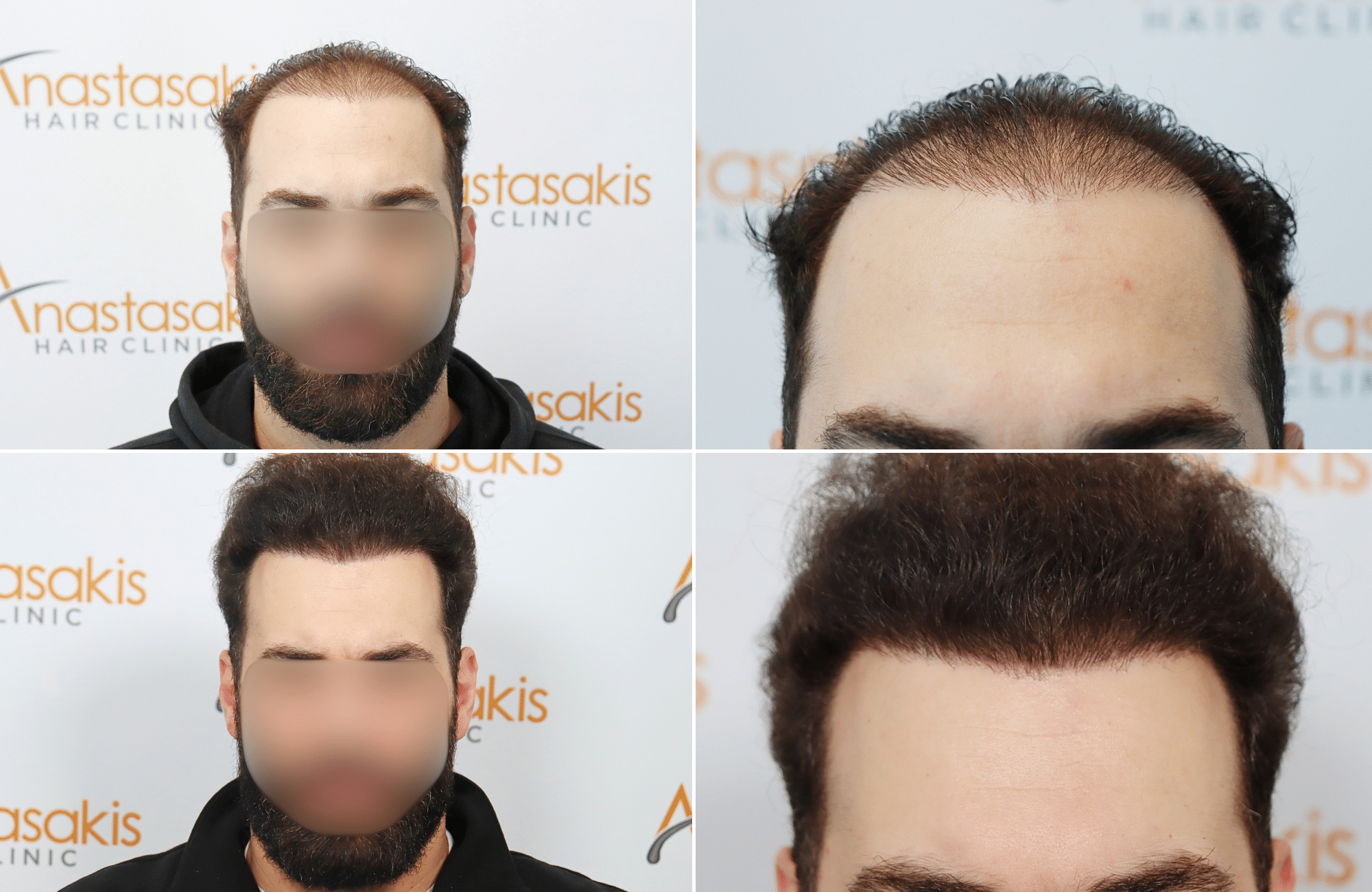 https://www.anastasakishairclinic.gr/portfolio/apotelesma-metamosxefsis-mallion-anastasakis-hair-clinic-74/