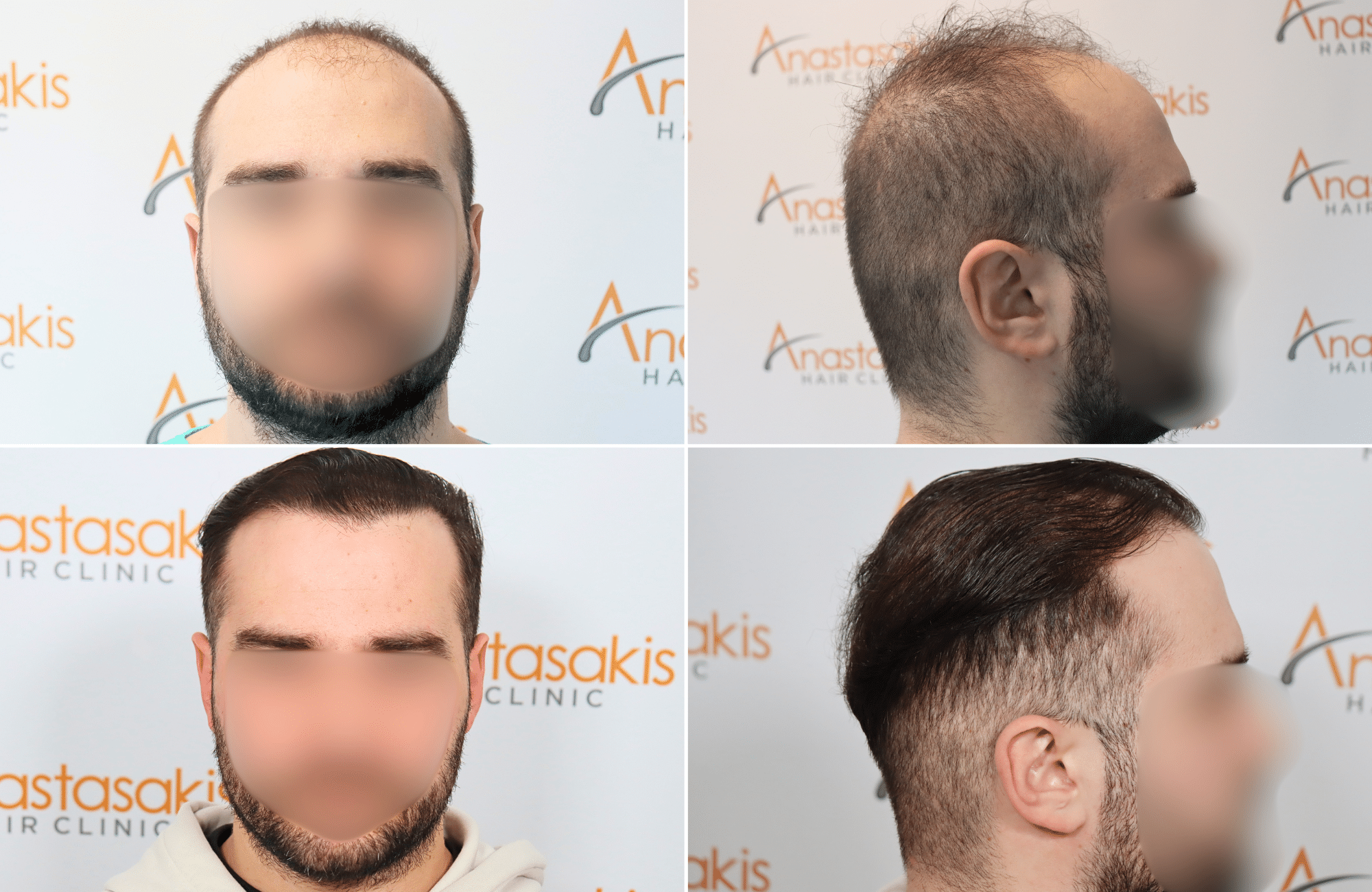 https://www.anastasakishairclinic.gr/portfolio/apotelesma-metamosxefsis-mallion-anastasakis-hair-clinic-86/