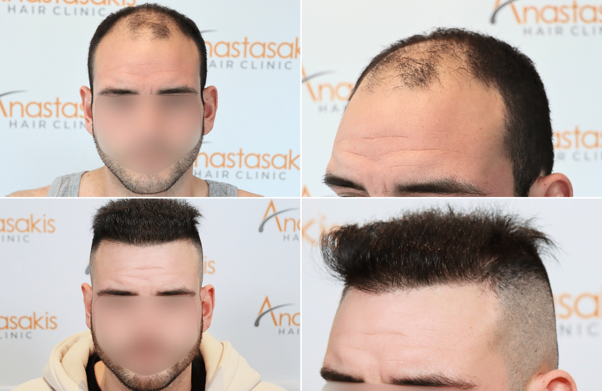 https://www.anastasakishairclinic.gr/portfolio/apotelesma-metamosxefsis-mallion-anastasakis-hair-clinic-134/
