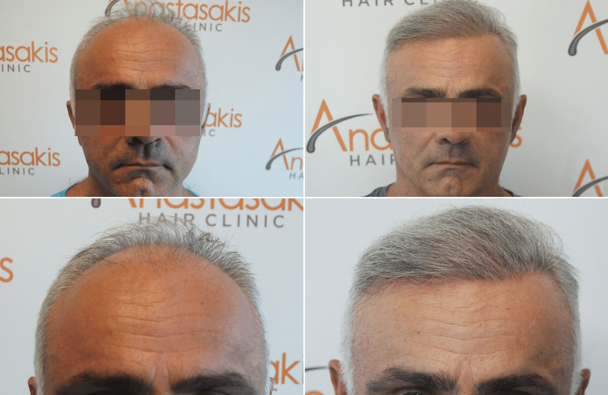 https://www.anastasakishairclinic.gr/portfolio/apotelesma-metamosxefsis-mallion-anastasakis-hair-clinic-83/