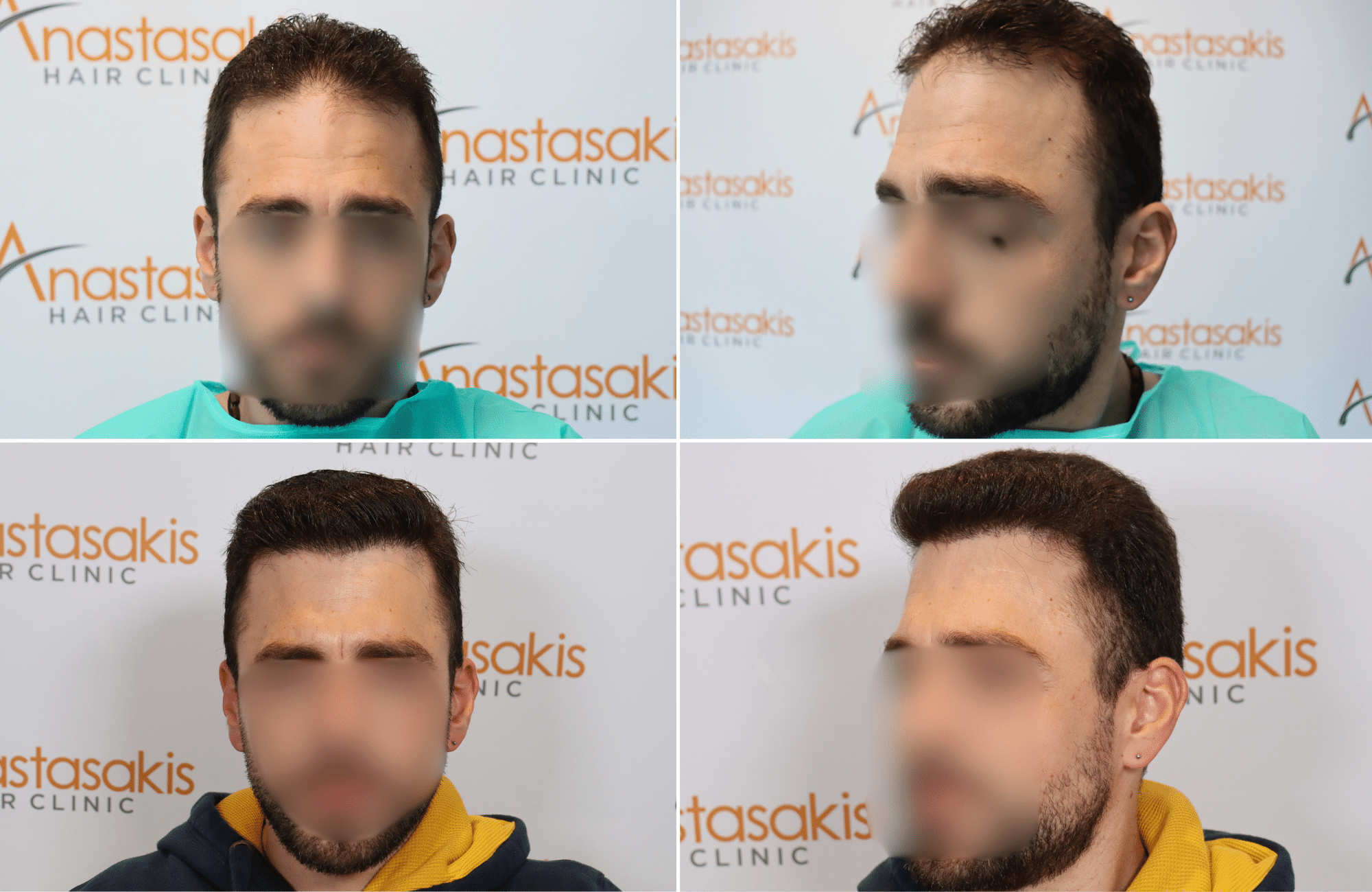 https://www.anastasakishairclinic.gr/portfolio/apotelesma-metamosxefsis-mallion-anastasakis-hair-clinic-20/
