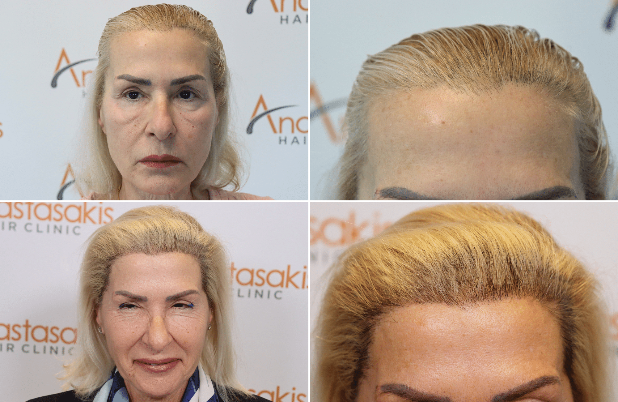 https://www.anastasakishairclinic.gr/portfolio/apotelesma-metamosxefsis-mallion-anastasakis-hair-clinic-188/