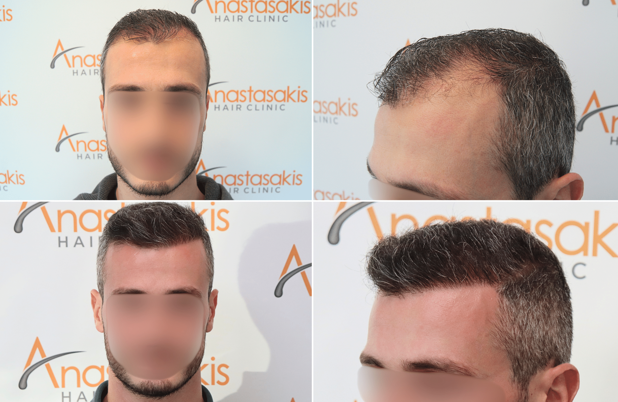https://www.anastasakishairclinic.gr/portfolio/apotelesma-metamosxefsis-mallion-anastasakis-hair-clinic-64/