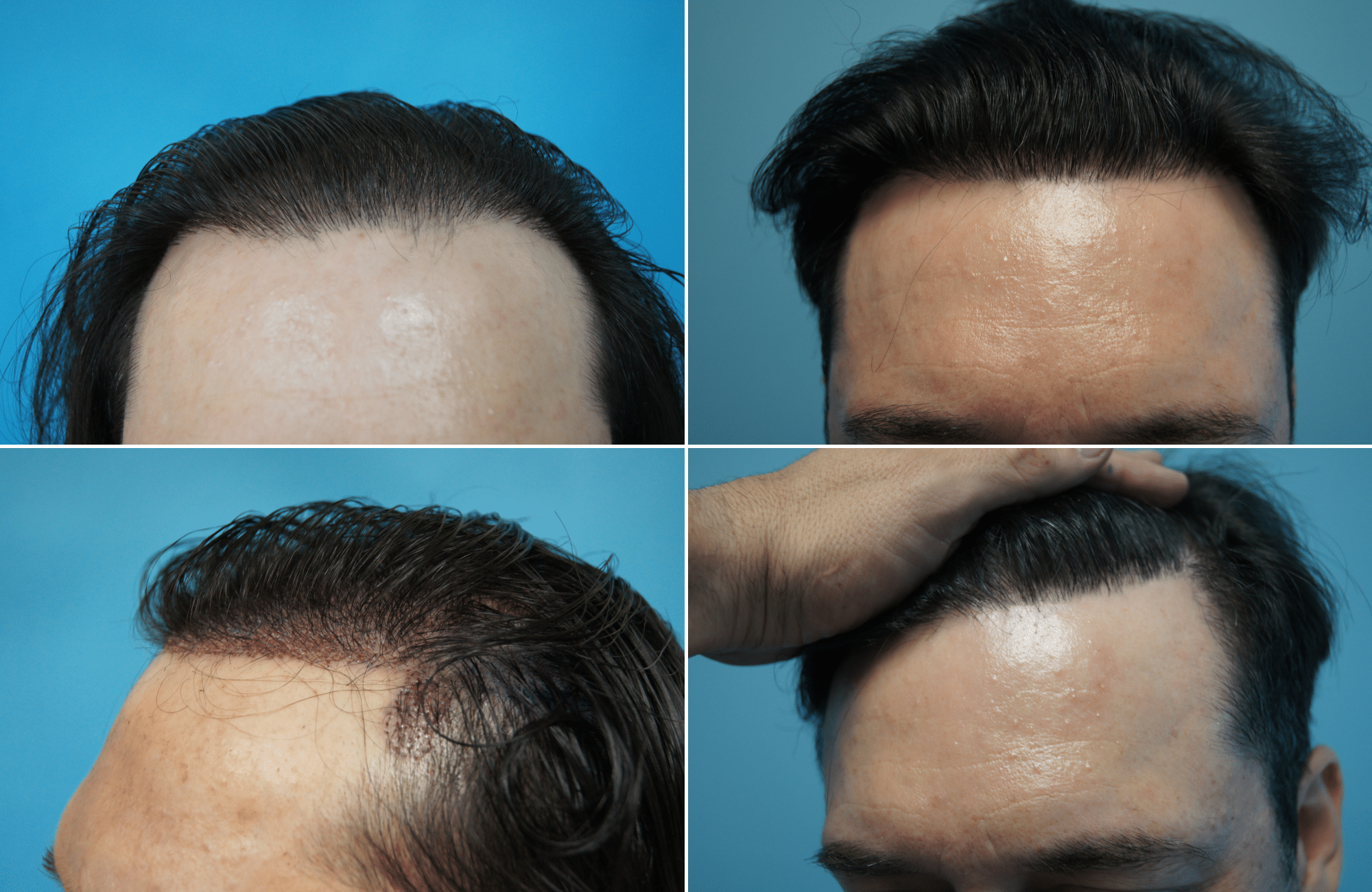 https://www.anastasakishairclinic.gr/portfolio/apotelesma-metamosxefsis-mallion-anastasakis-hair-clinic-78/