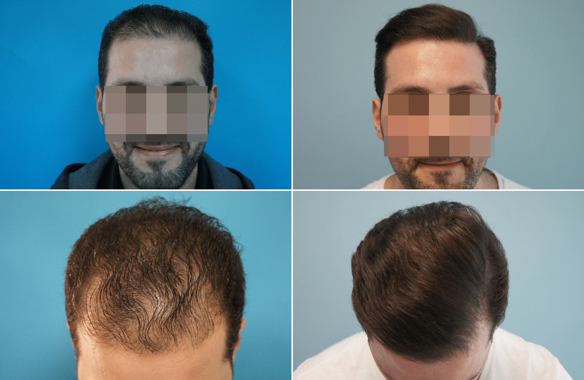 https://www.anastasakishairclinic.gr/portfolio/apotelesma-metamosxefsis-mallion-anastasakis-hair-clinic-91/