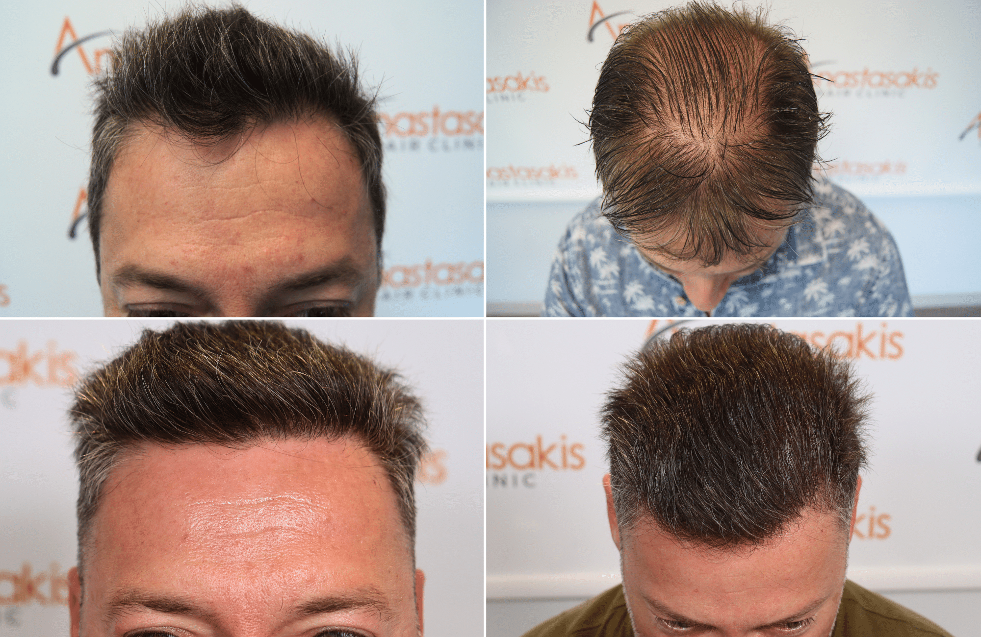 https://www.anastasakishairclinic.gr/portfolio/apotelesma-metamosxefsis-mallion-anastasakis-hair-clinic-31/