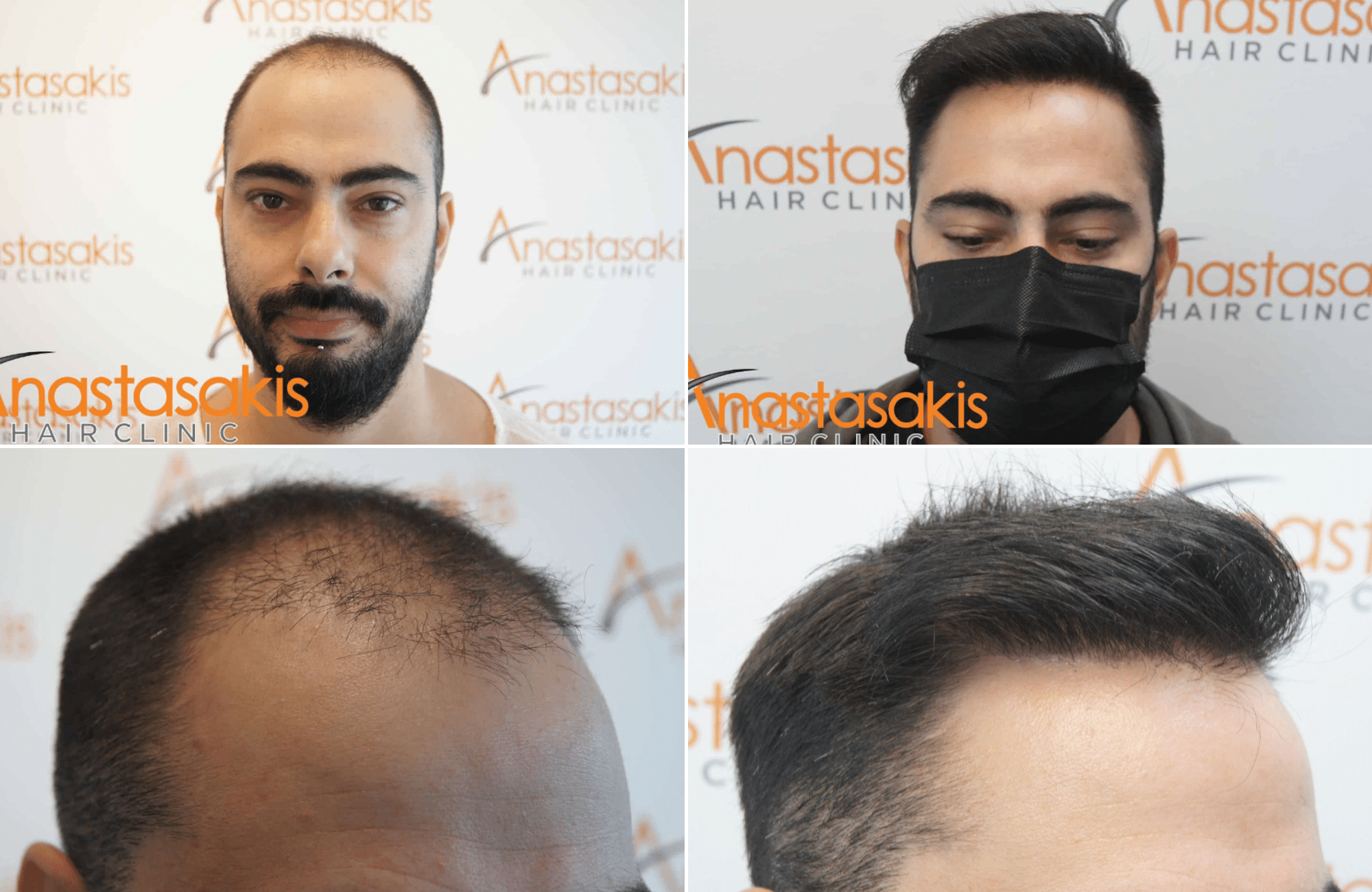 https://www.anastasakishairclinic.gr/portfolio/apotelesma-metamosxefsis-mallion-anastasakis-hair-clinic-135/