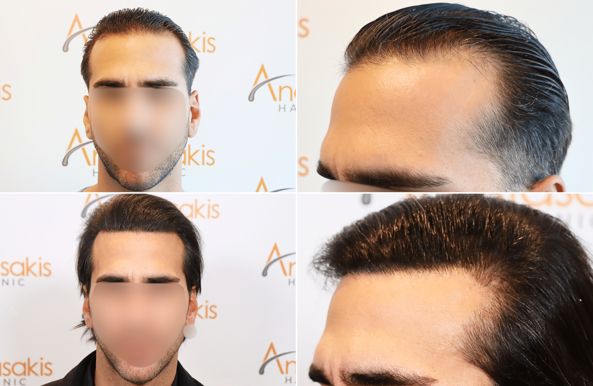 https://www.anastasakishairclinic.gr/portfolio/apotelesma-metamosxefsis-mallion-anastasakis-hair-clinic-136/