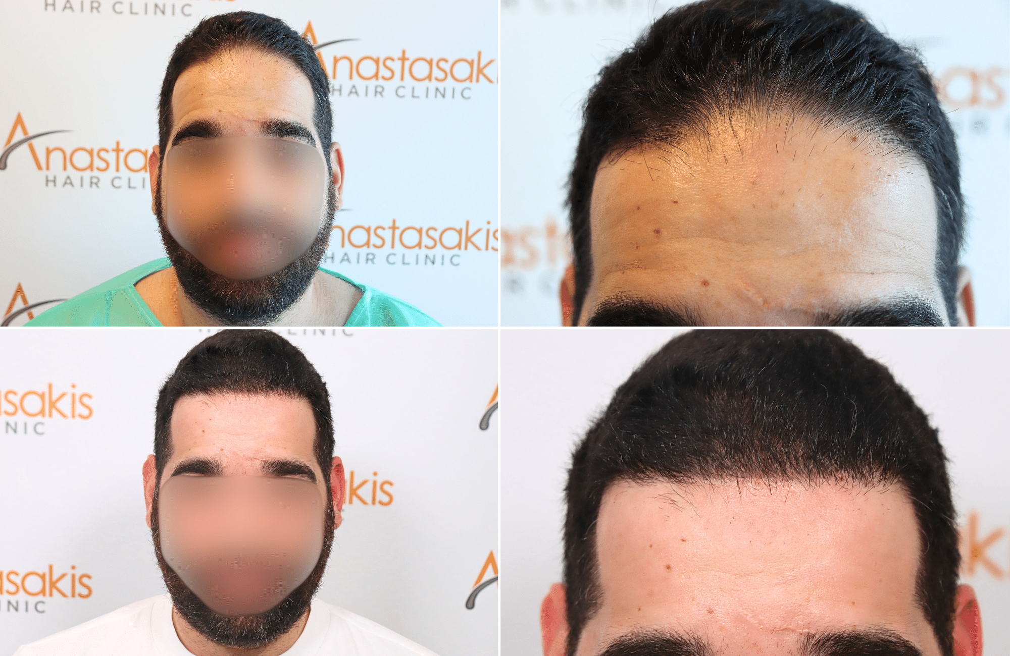 https://www.anastasakishairclinic.gr/portfolio/apotelesma-metamosxefsis-mallion-anastasakis-hair-clinic-68/