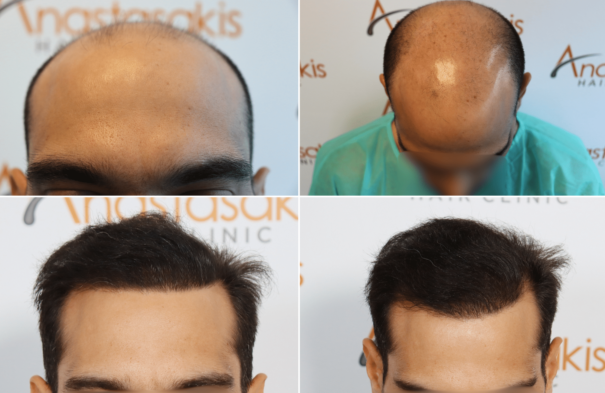 https://www.anastasakishairclinic.gr/portfolio/apotelesma-metamosxefsis-mallion-anastasakis-hair-clinic-54/