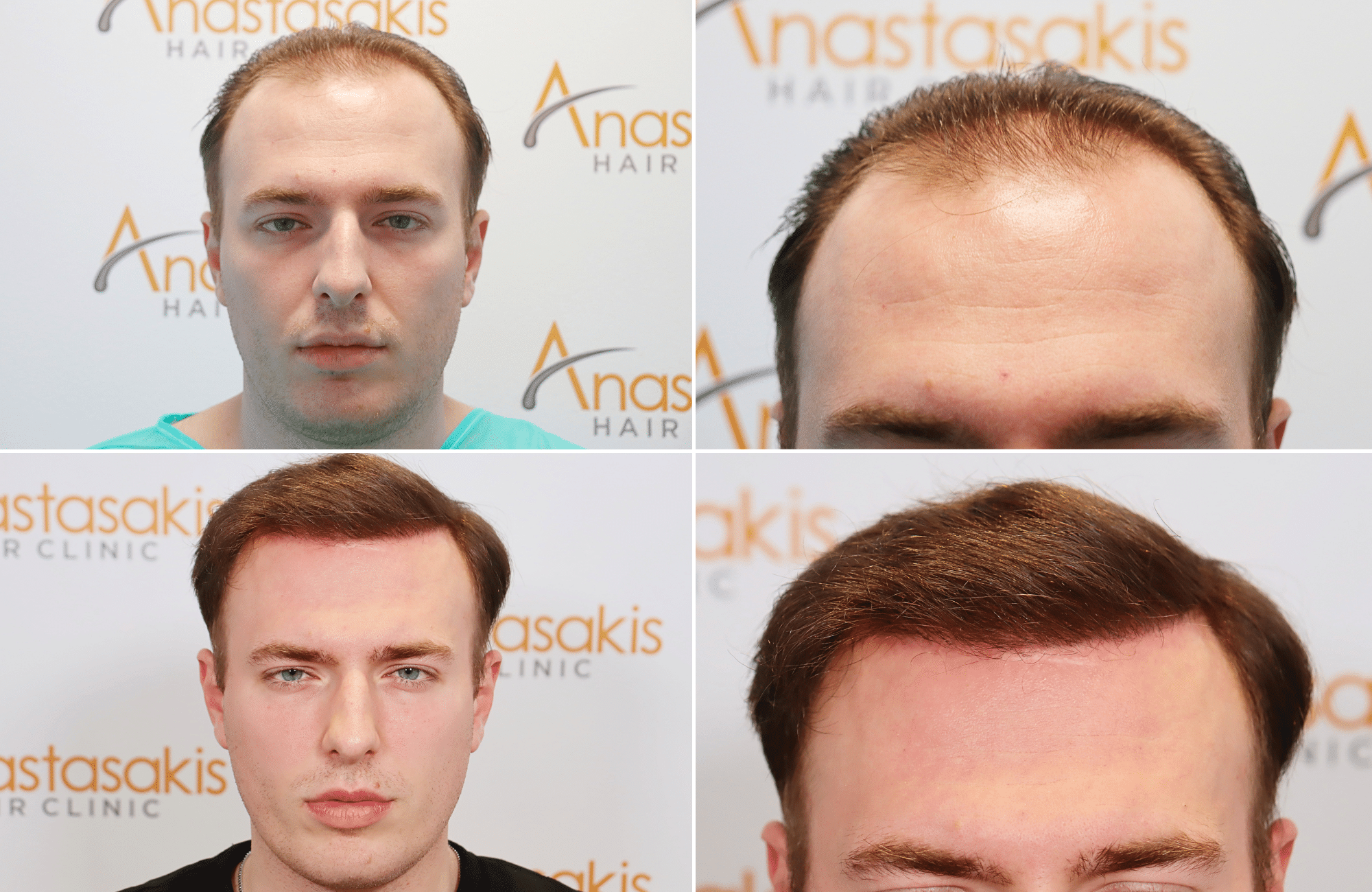 https://www.anastasakishairclinic.gr/portfolio/apotelesma-metamosxefsis-mallion-anastasakis-hair-clinic-117/