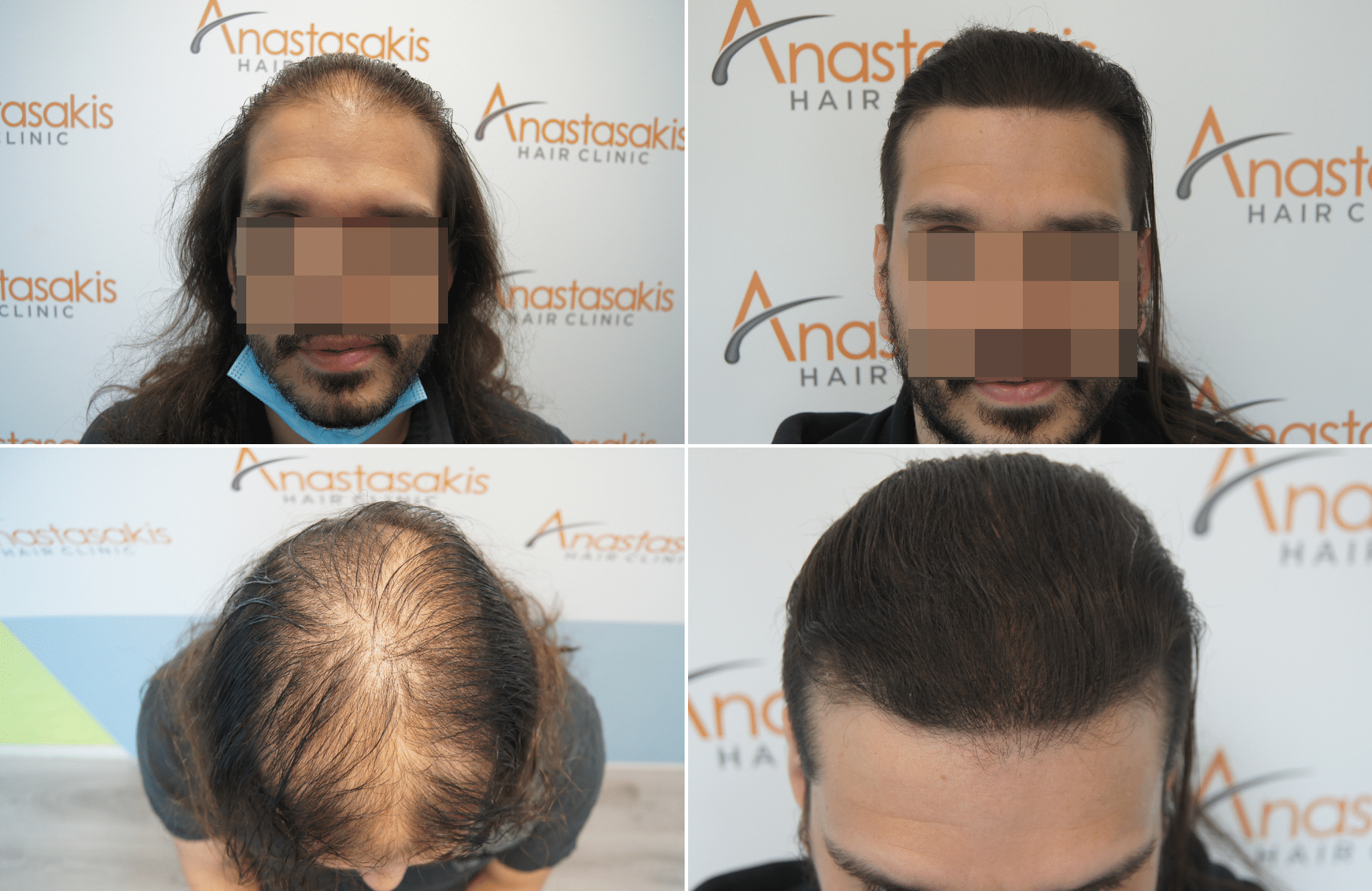 https://www.anastasakishairclinic.gr/portfolio/apotelesma-metamosxefsis-mallion-anastasakis-hair-clinic-53/