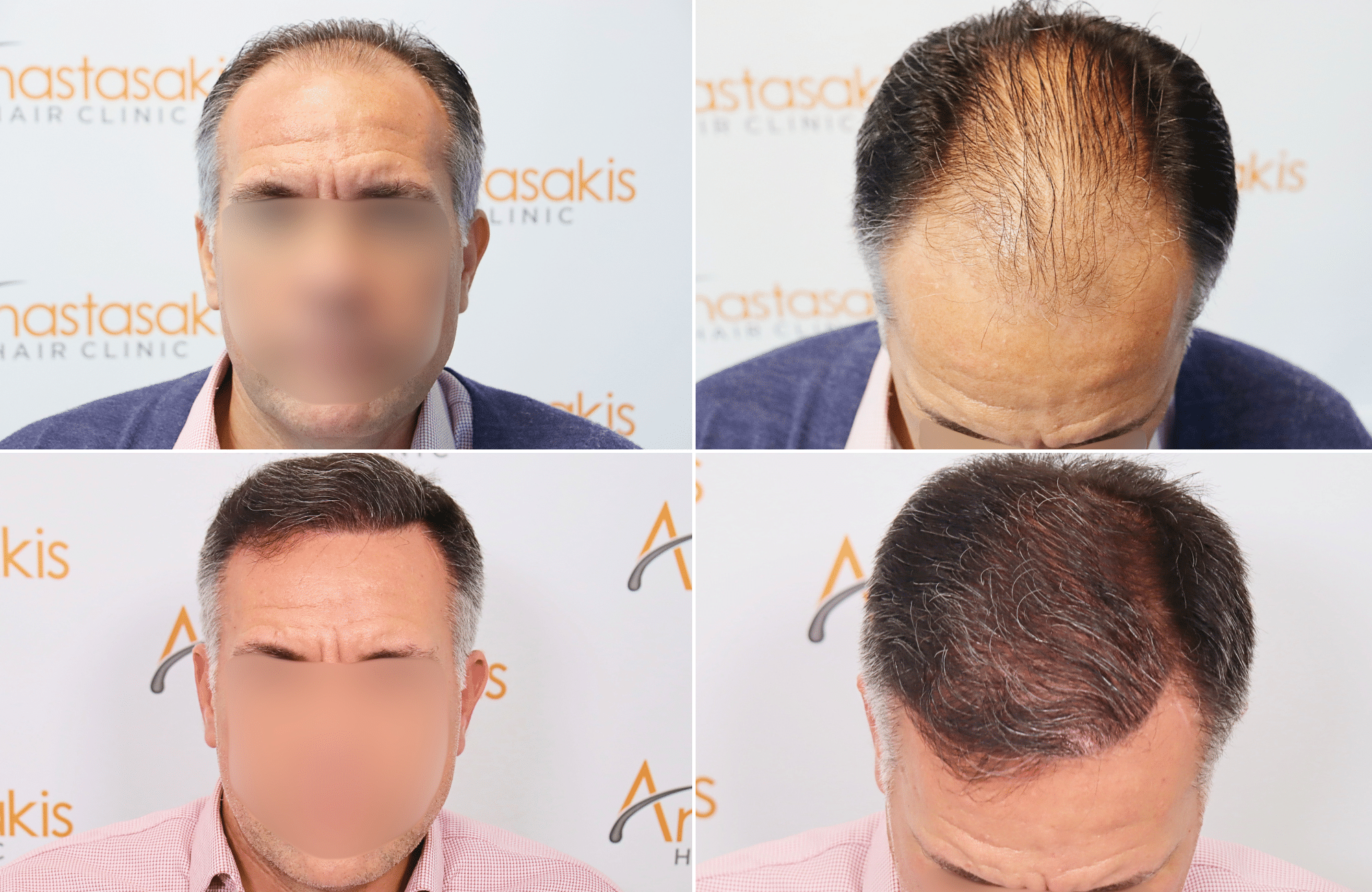 https://www.anastasakishairclinic.gr/portfolio/apotelesma-metamosxefsis-mallion-anastasakis-hair-clinic-127/