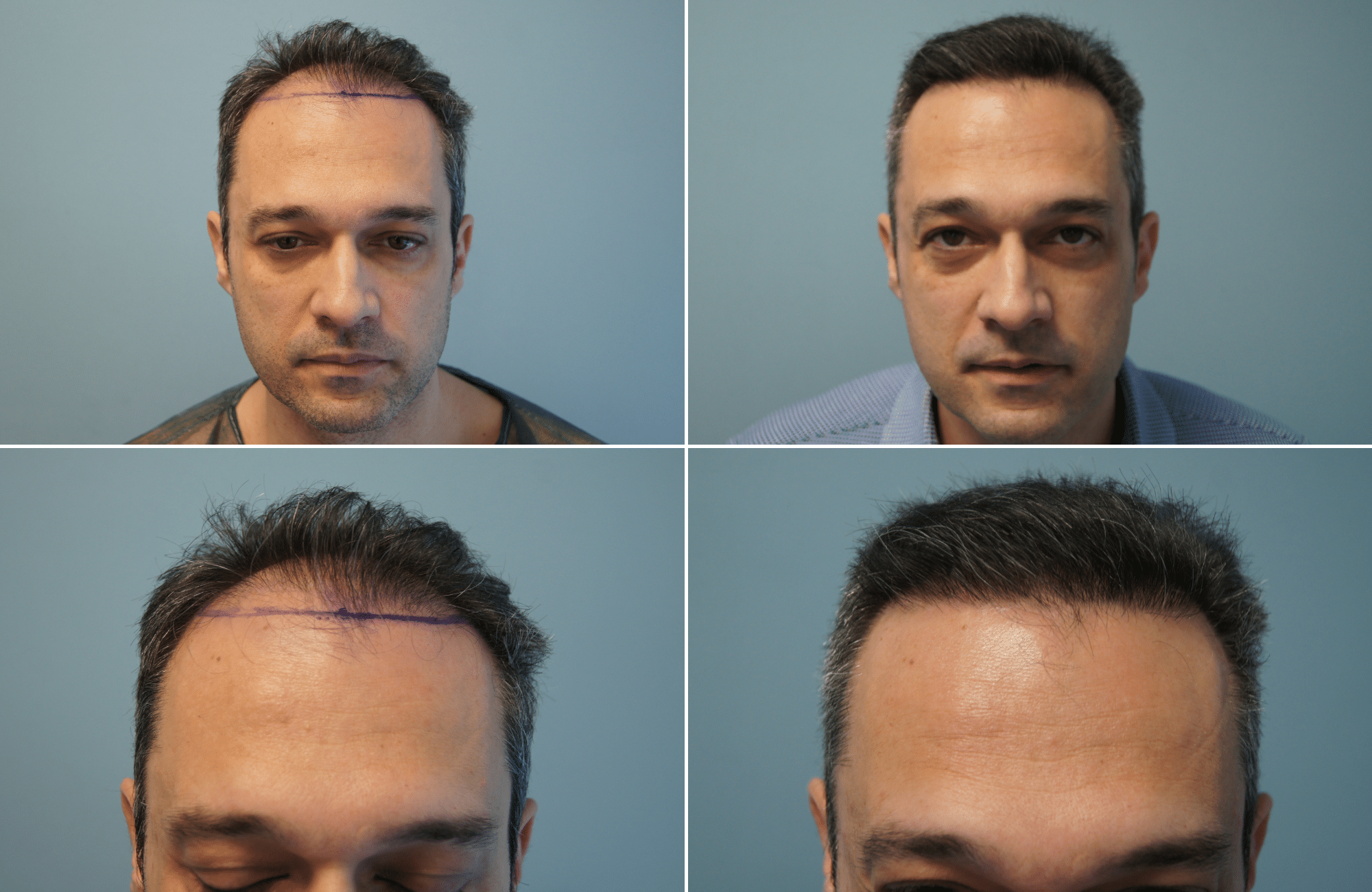 https://www.anastasakishairclinic.gr/portfolio/apotelesma-metamosxefsis-mallion-anastasakis-hair-clinic-212/