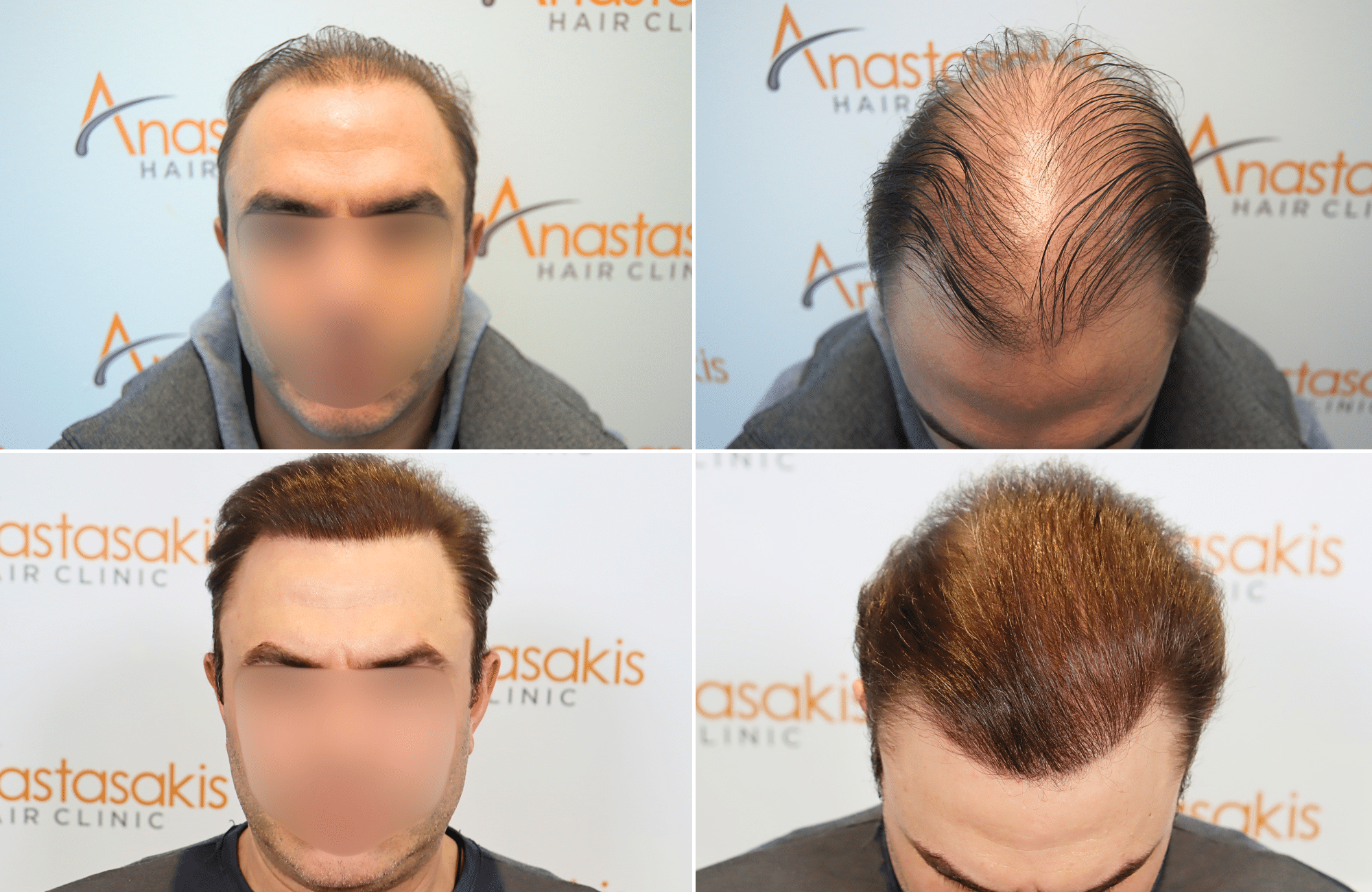 https://www.anastasakishairclinic.gr/portfolio/apotelesma-metamosxefsis-mallion-anastasakis-hair-clinic-69/