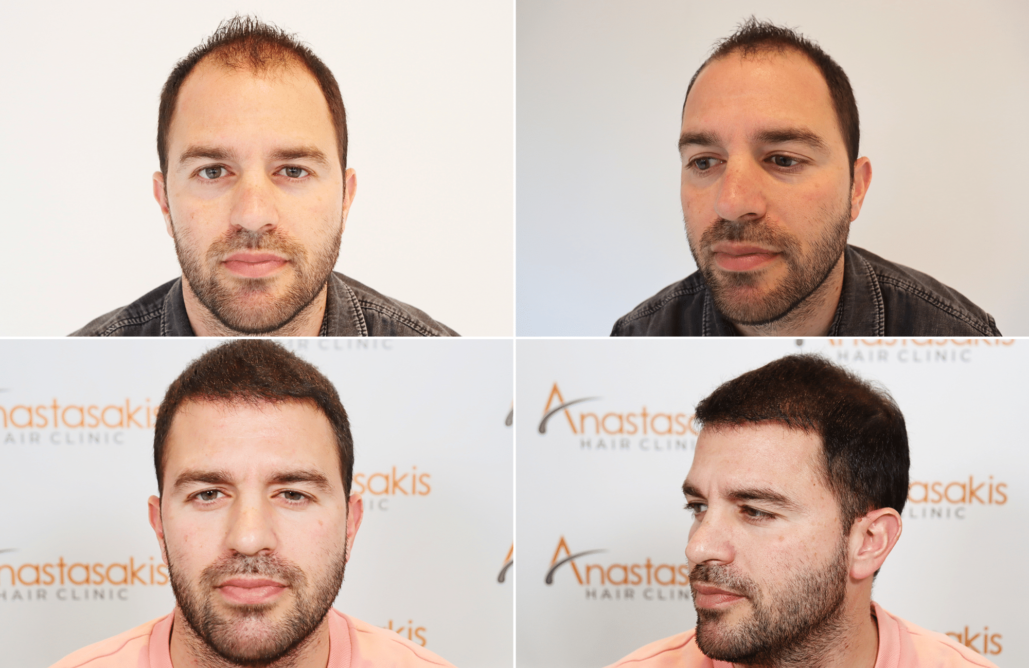 https://www.anastasakishairclinic.gr/portfolio/apotelesma-metamosxefsis-mallion-anastasakis-hair-clinic-92/