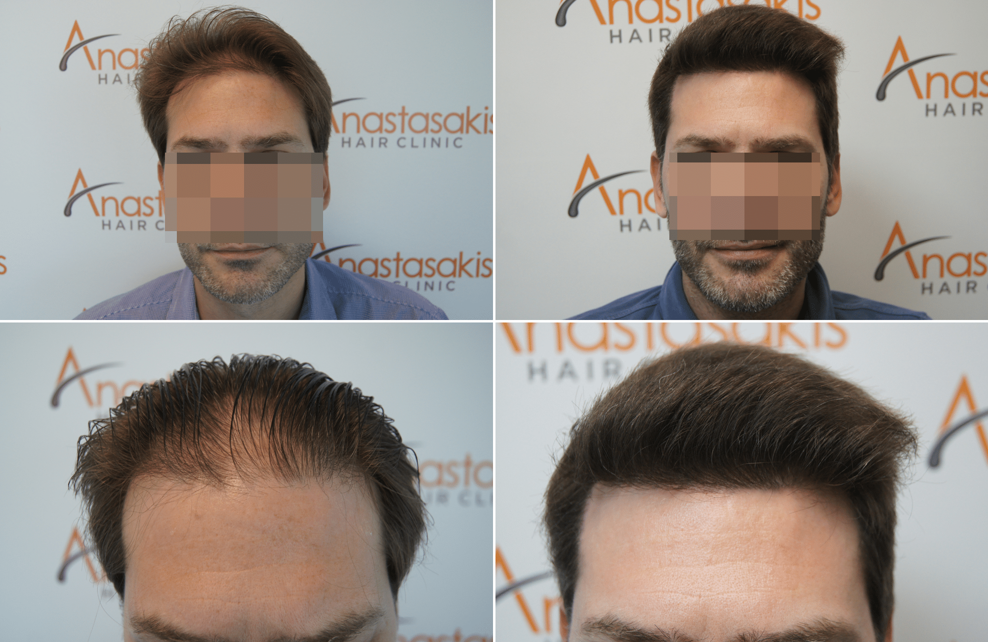 https://www.anastasakishairclinic.gr/portfolio/apotelesma-metamosxefsis-mallion-anastasakis-hair-clinic-101/