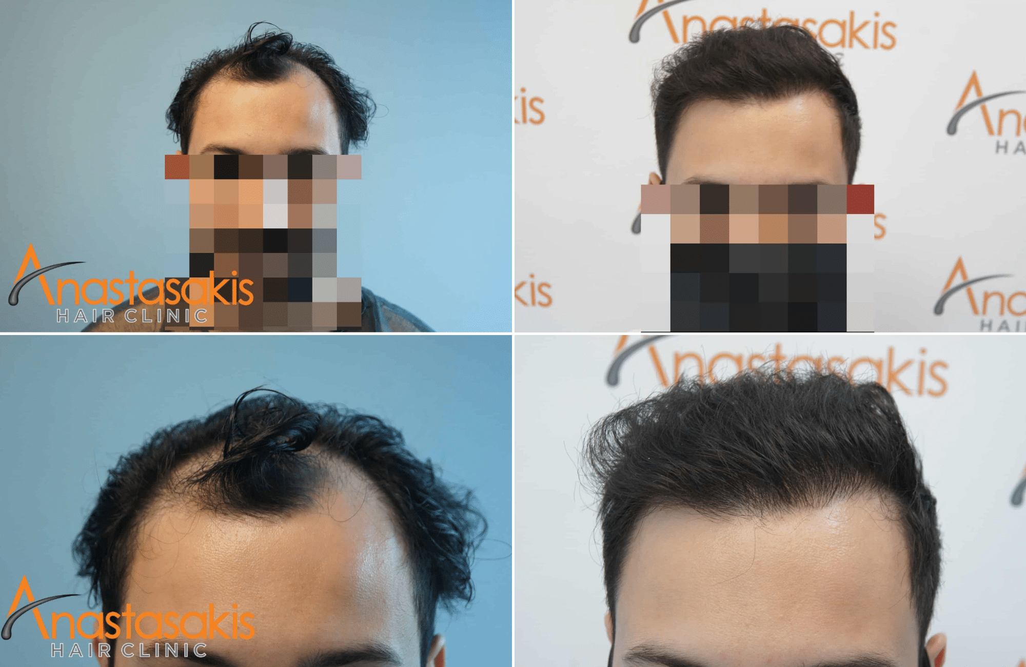 https://www.anastasakishairclinic.gr/portfolio/apotelesma-me-1860-fus-apokatastasi-hairline/