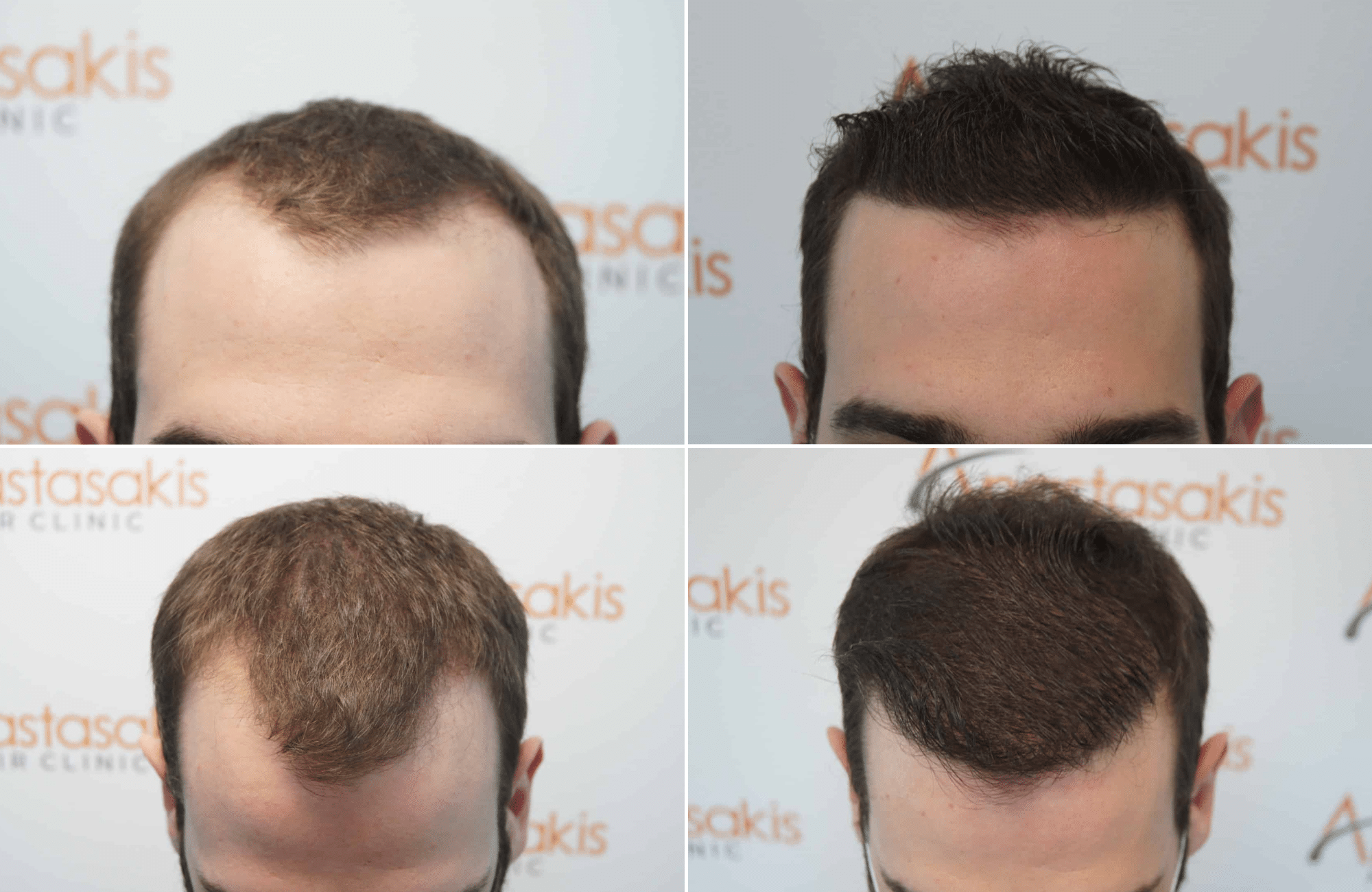 https://www.anastasakishairclinic.gr/portfolio/apotelesma-metamosxefsis-mallion-anastasakis-hair-clinic-246/