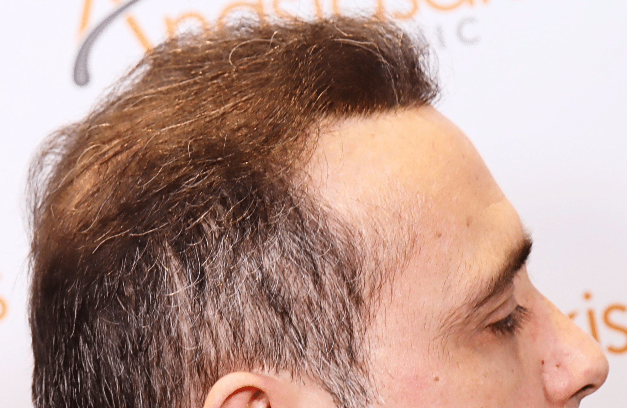 HAIR TRANSPLANT RESULT 3000 FUS STAGE 6 THIN 1ST STAGE