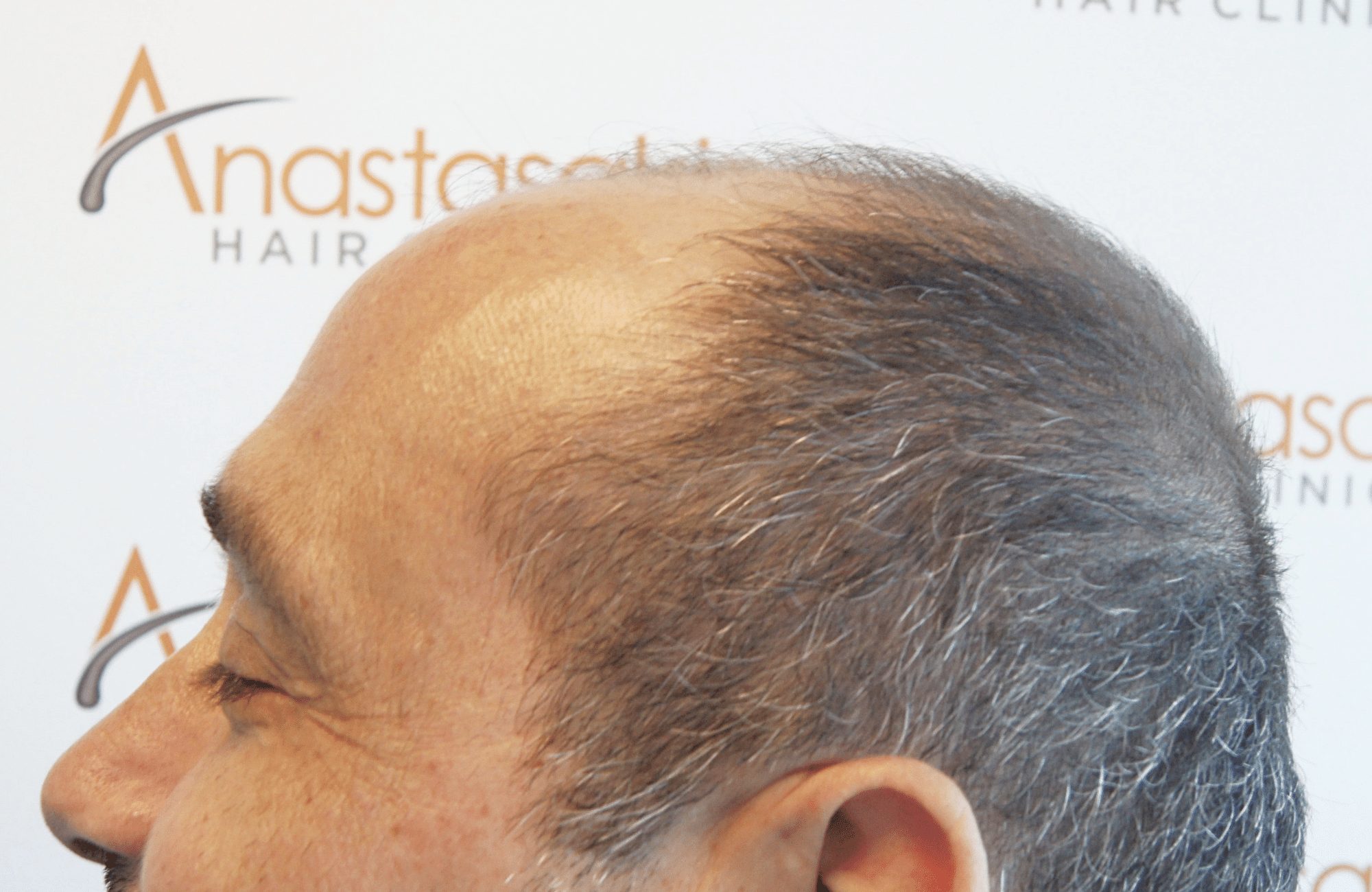 HAIR TRANSPLANT RESULT 3000 FUS STAGE 6 THIN 1ST STAGE
