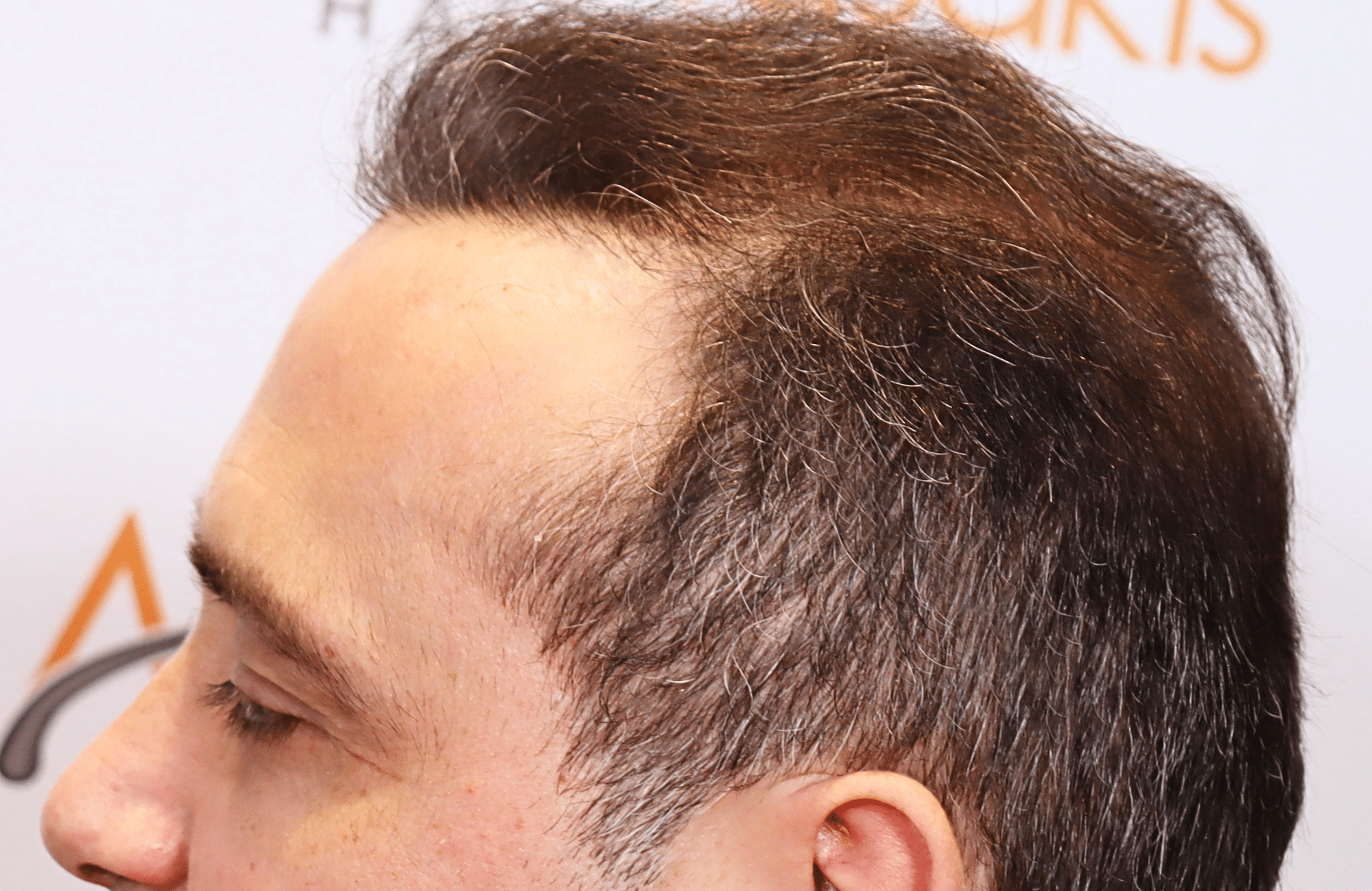 HAIR TRANSPLANT RESULT 3000 FUS STAGE 6 THIN 1ST STAGE