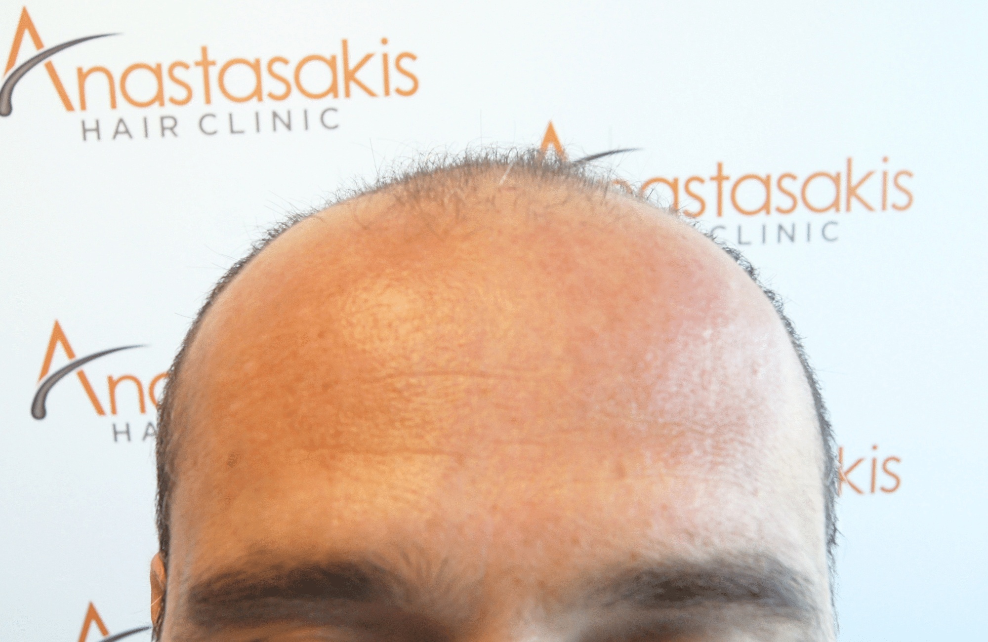 HAIR TRANSPLANT RESULT 3000 FUS STAGE 6 THIN 1ST STAGE