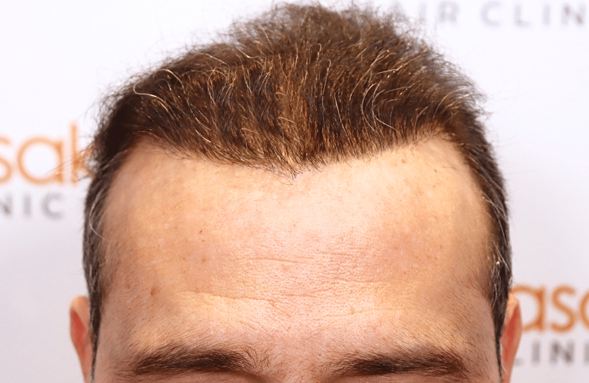 HAIR TRANSPLANT RESULT 3000 FUS STAGE 6 THIN 1ST STAGE