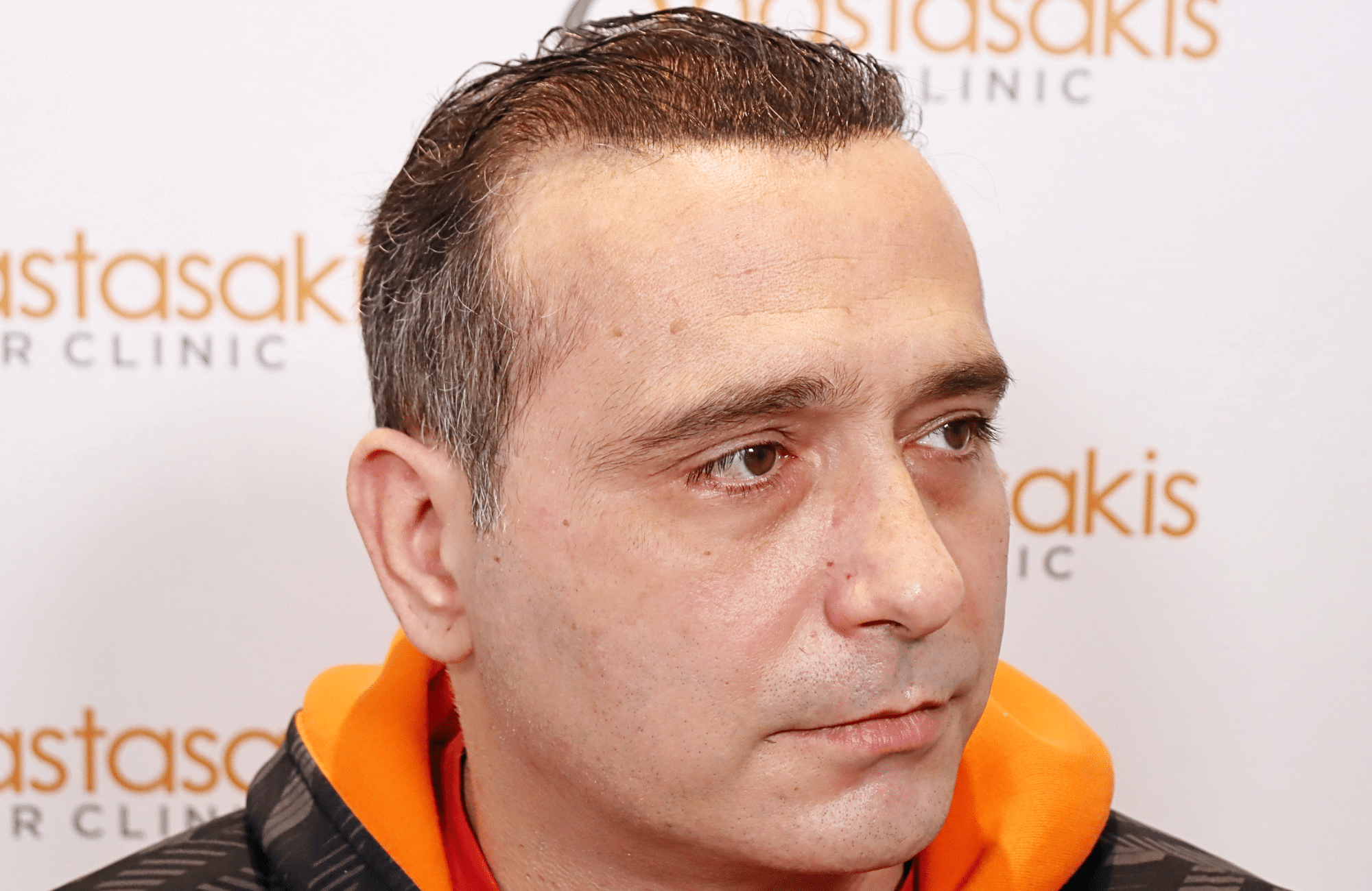 HAIR TRANSPLANT RESULT 3000 FUS STAGE 6 THIN 1ST STAGE