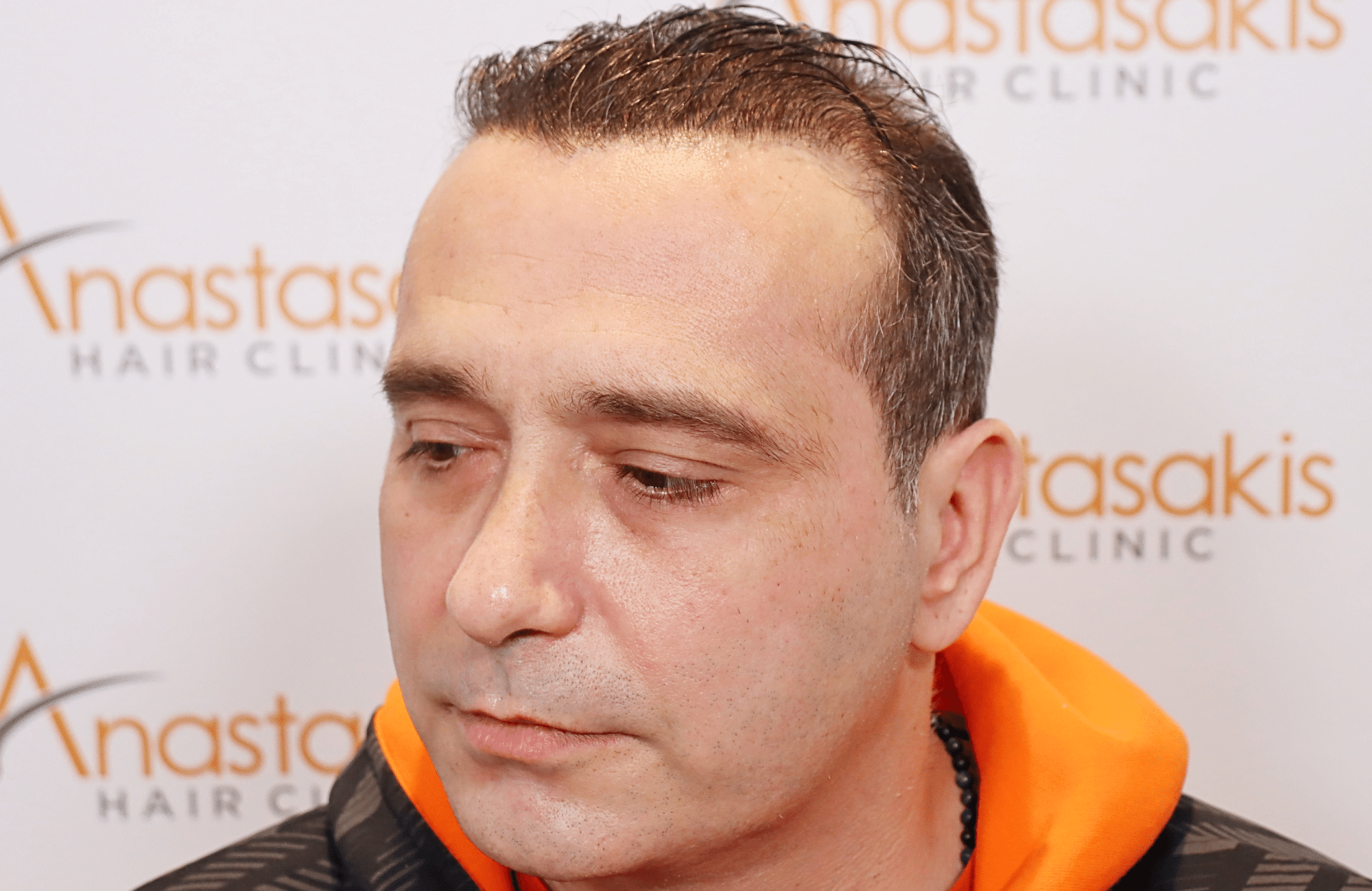HAIR TRANSPLANT RESULT 3000 FUS STAGE 6 THIN 1ST STAGE