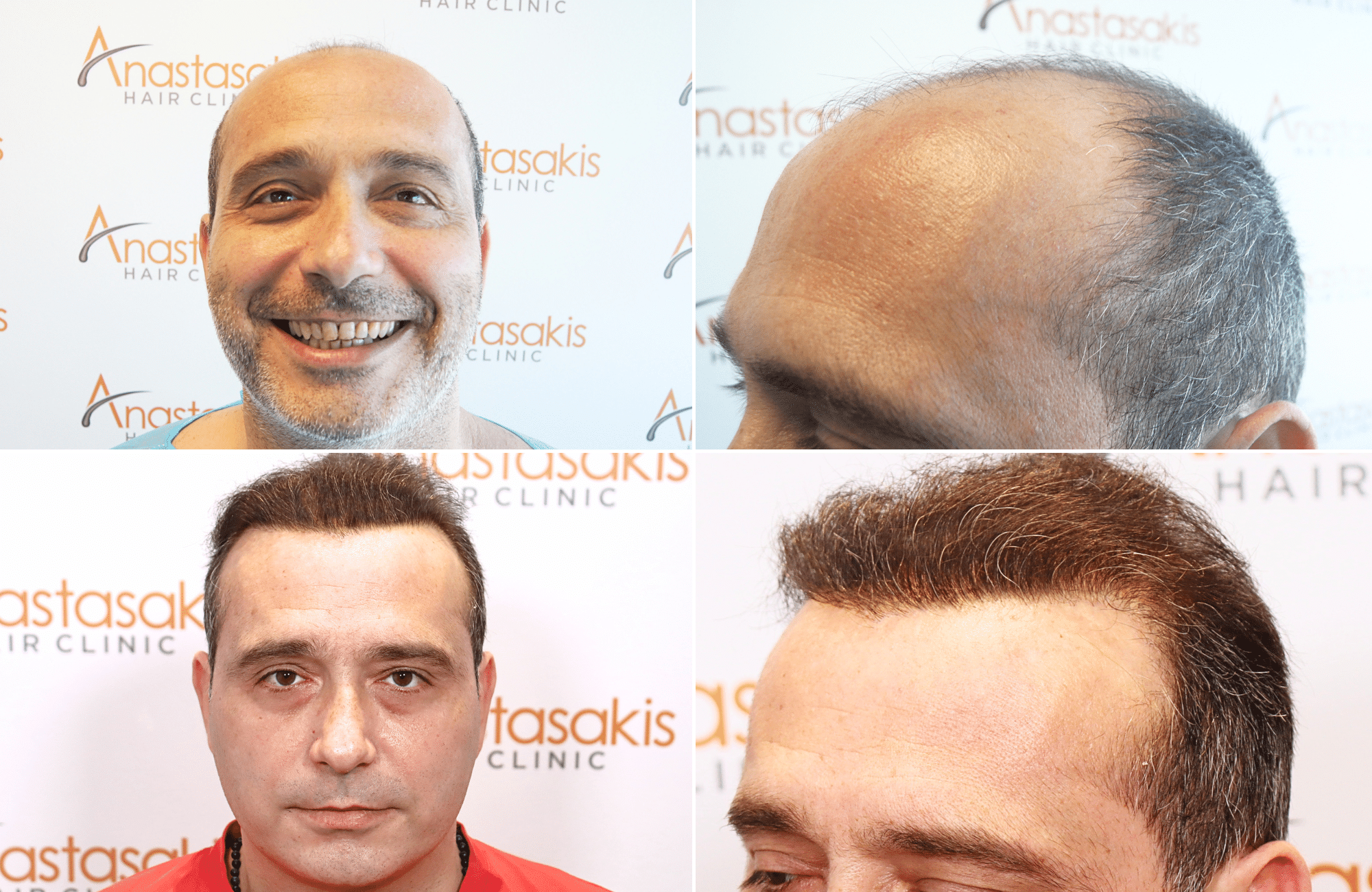 https://www.anastasakishairclinic.gr/portfolio/apotelesma-metamosxefsis-mallion-anastasakis-hair-clinic-323/