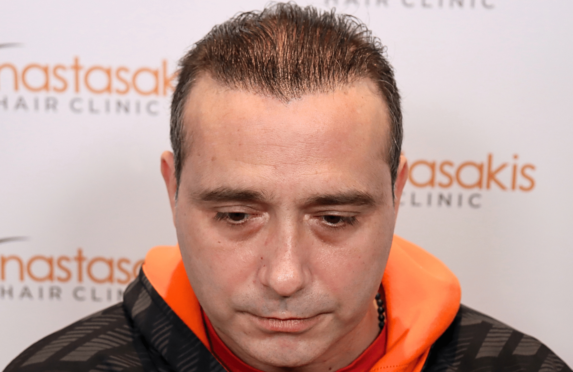 HAIR TRANSPLANT RESULT 3000 FUS STAGE 6 THIN 1ST STAGE