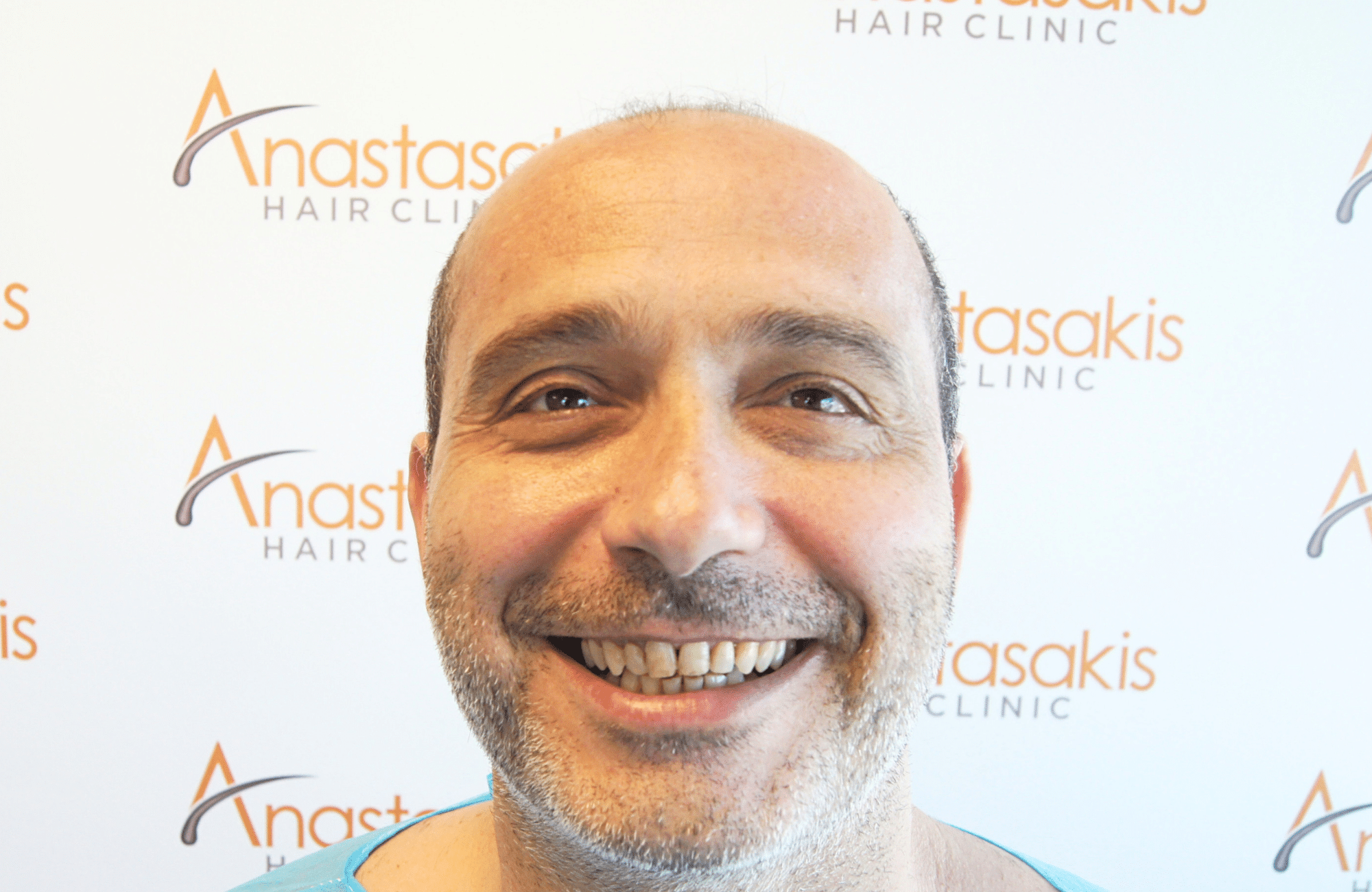 HAIR TRANSPLANT RESULT 3000 FUS STAGE 6 THIN 1ST STAGE