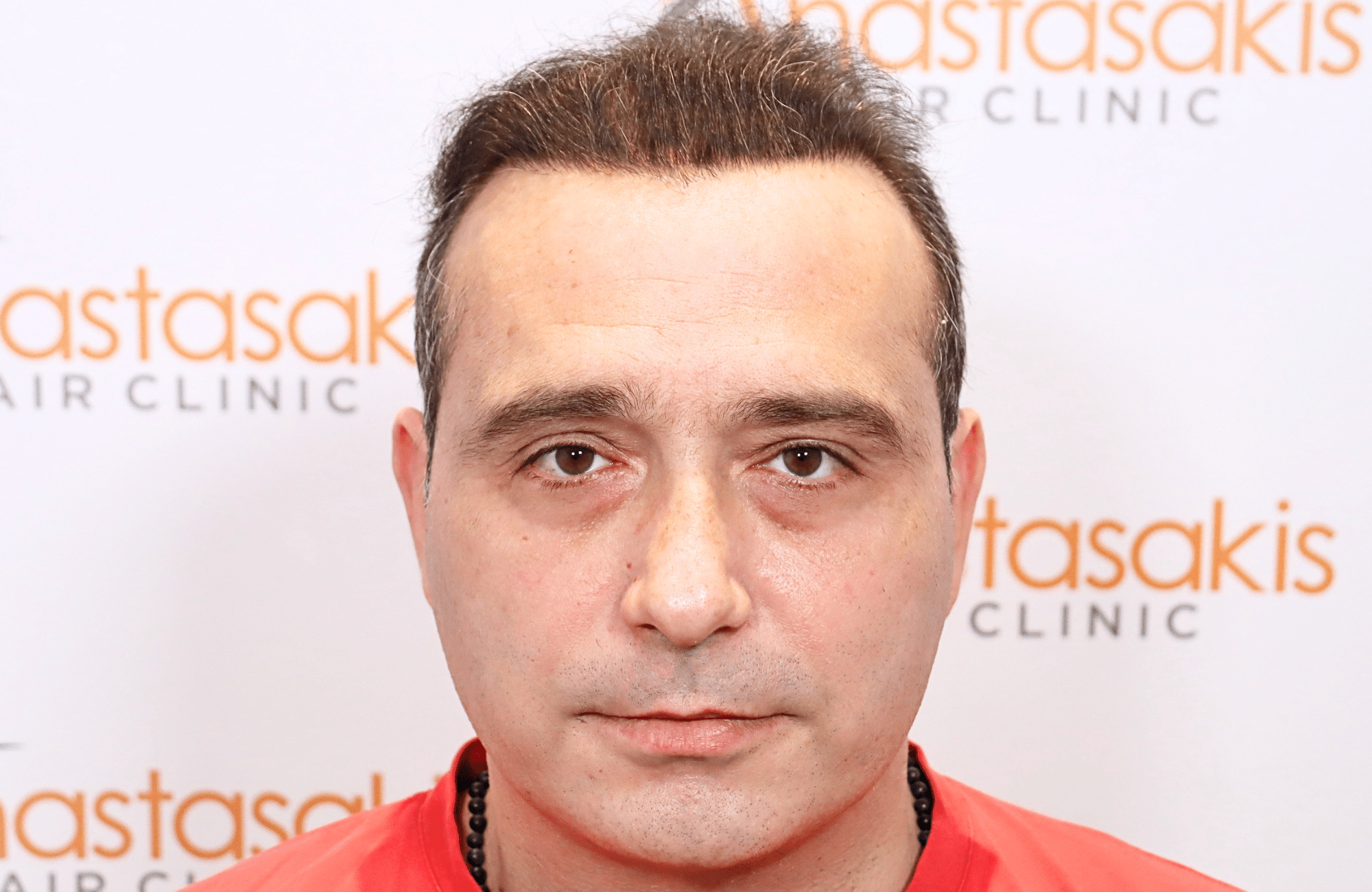 HAIR TRANSPLANT RESULT 3000 FUS STAGE 6 THIN 1ST STAGE