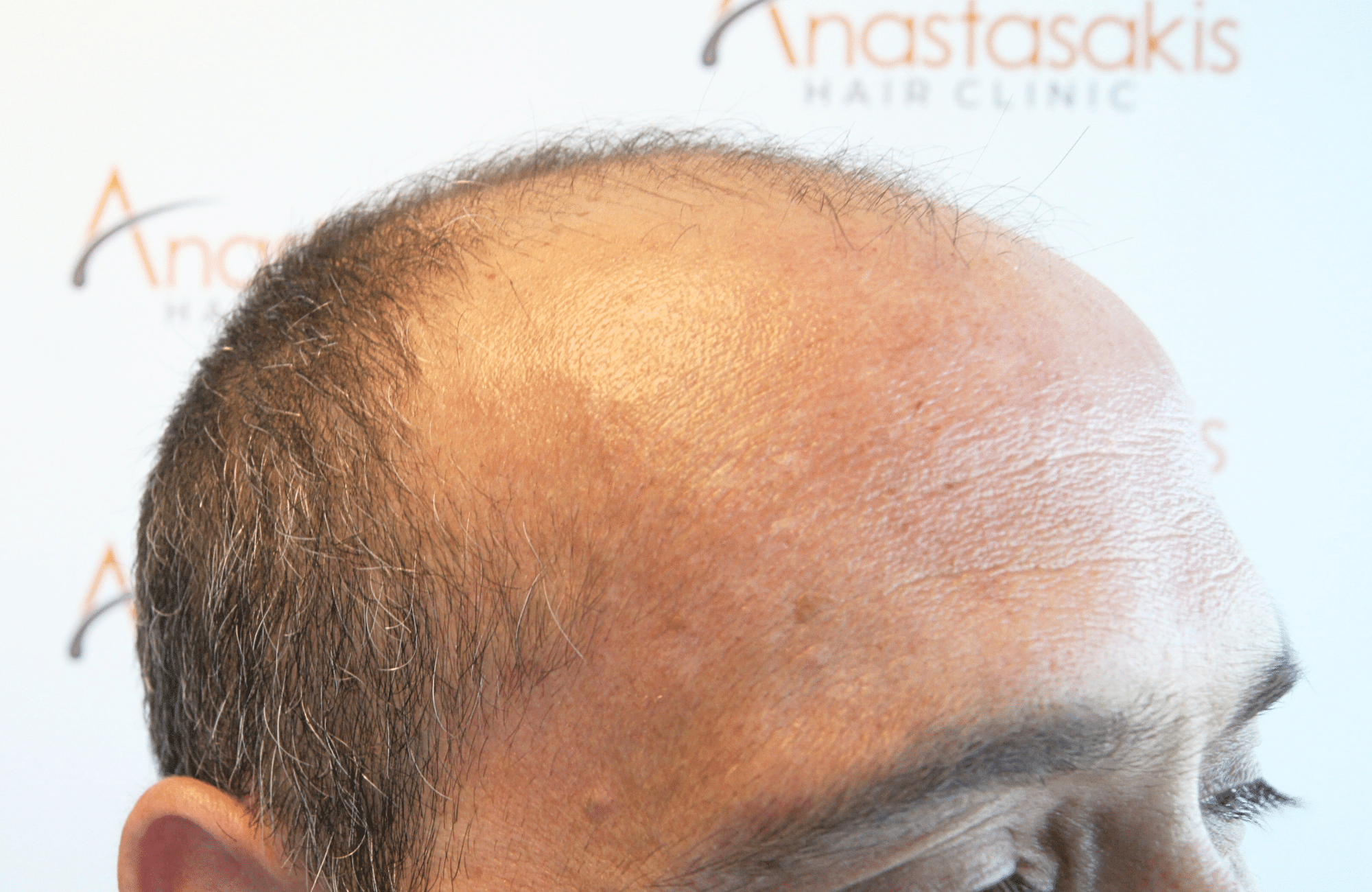 HAIR TRANSPLANT RESULT 3000 FUS STAGE 6 THIN 1ST STAGE