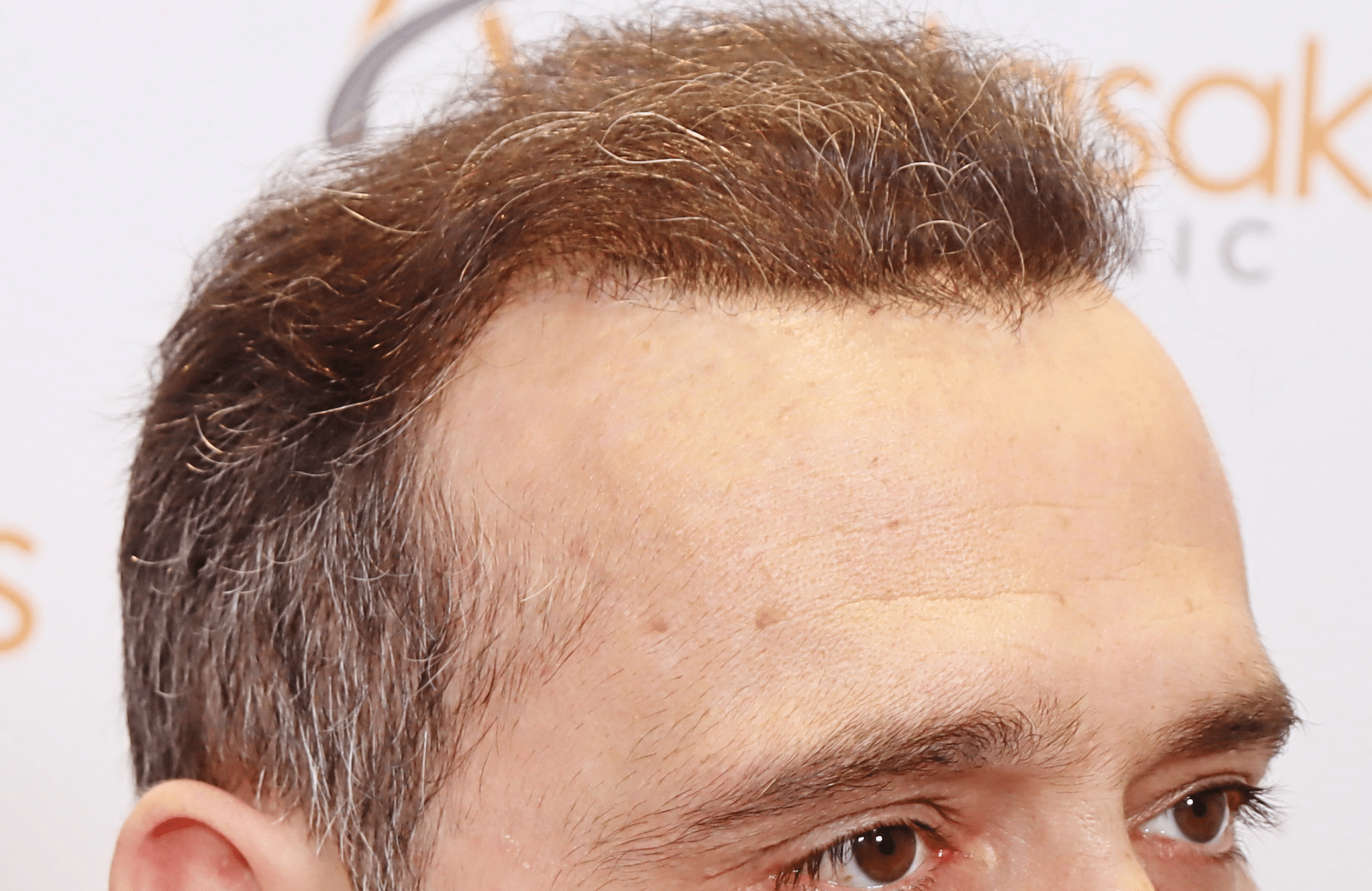 HAIR TRANSPLANT RESULT 3000 FUS STAGE 6 THIN 1ST STAGE
