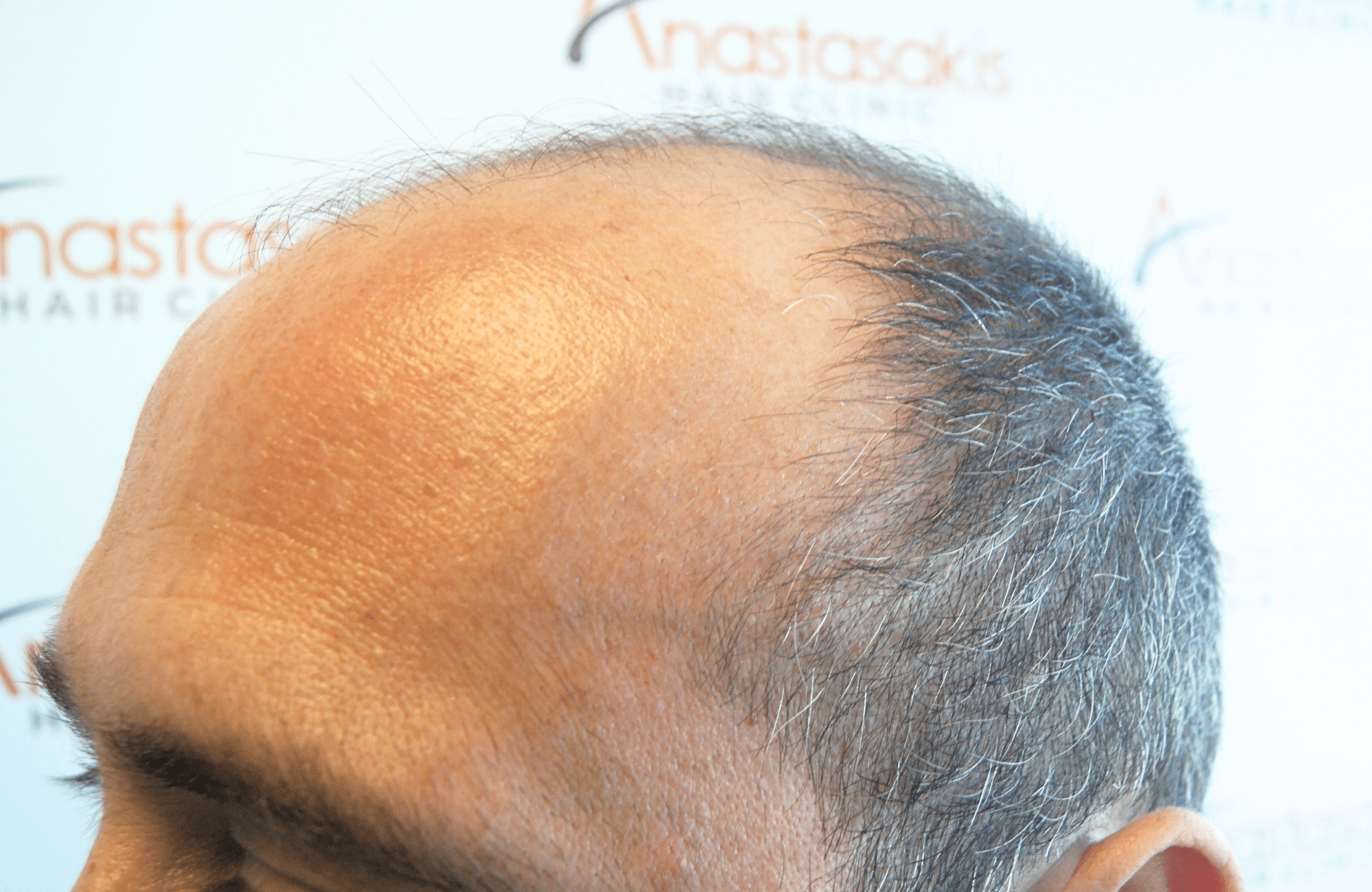 HAIR TRANSPLANT RESULT 3000 FUS STAGE 6 THIN 1ST STAGE