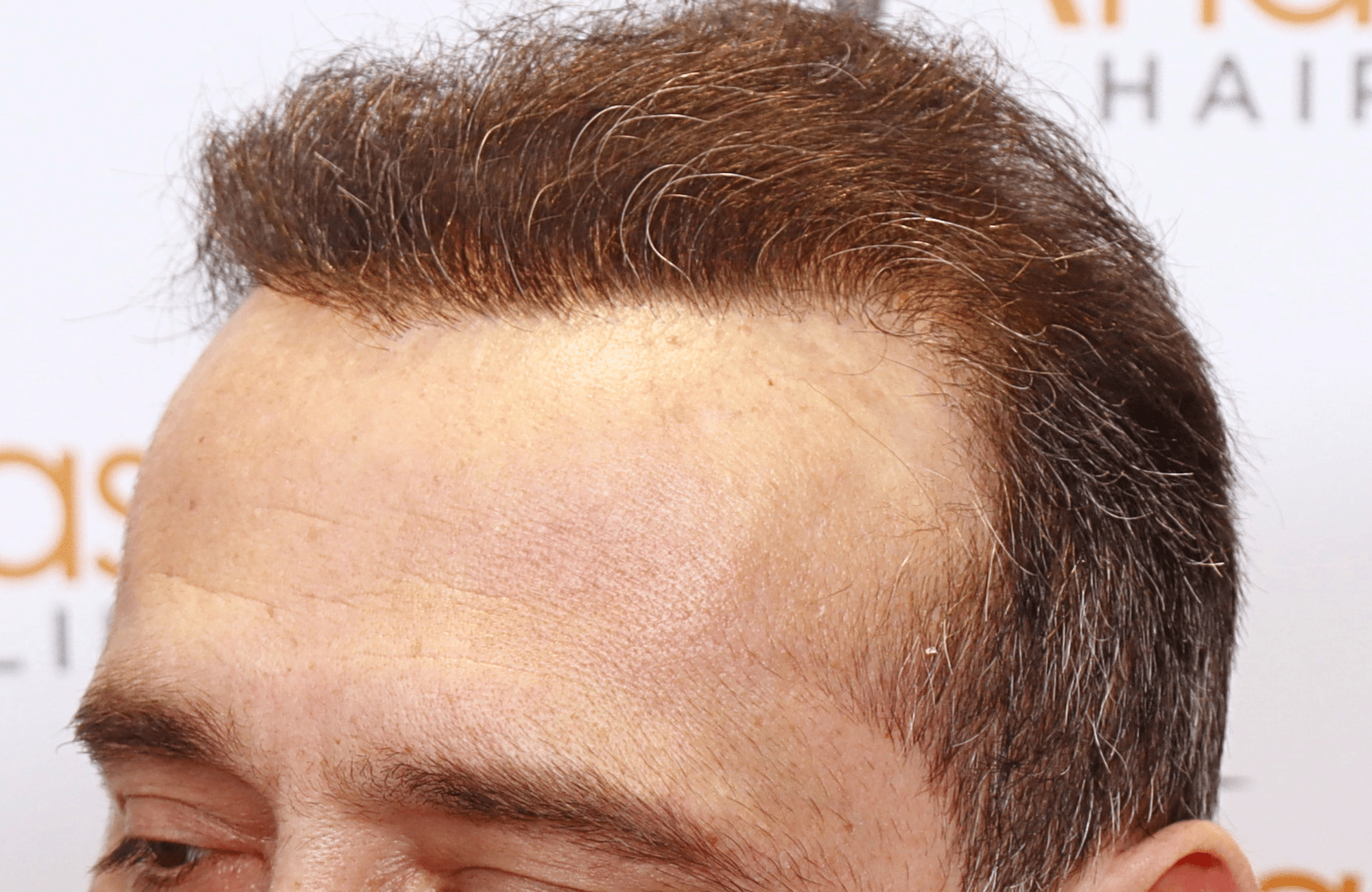 HAIR TRANSPLANT RESULT 3000 FUS STAGE 6 THIN 1ST STAGE