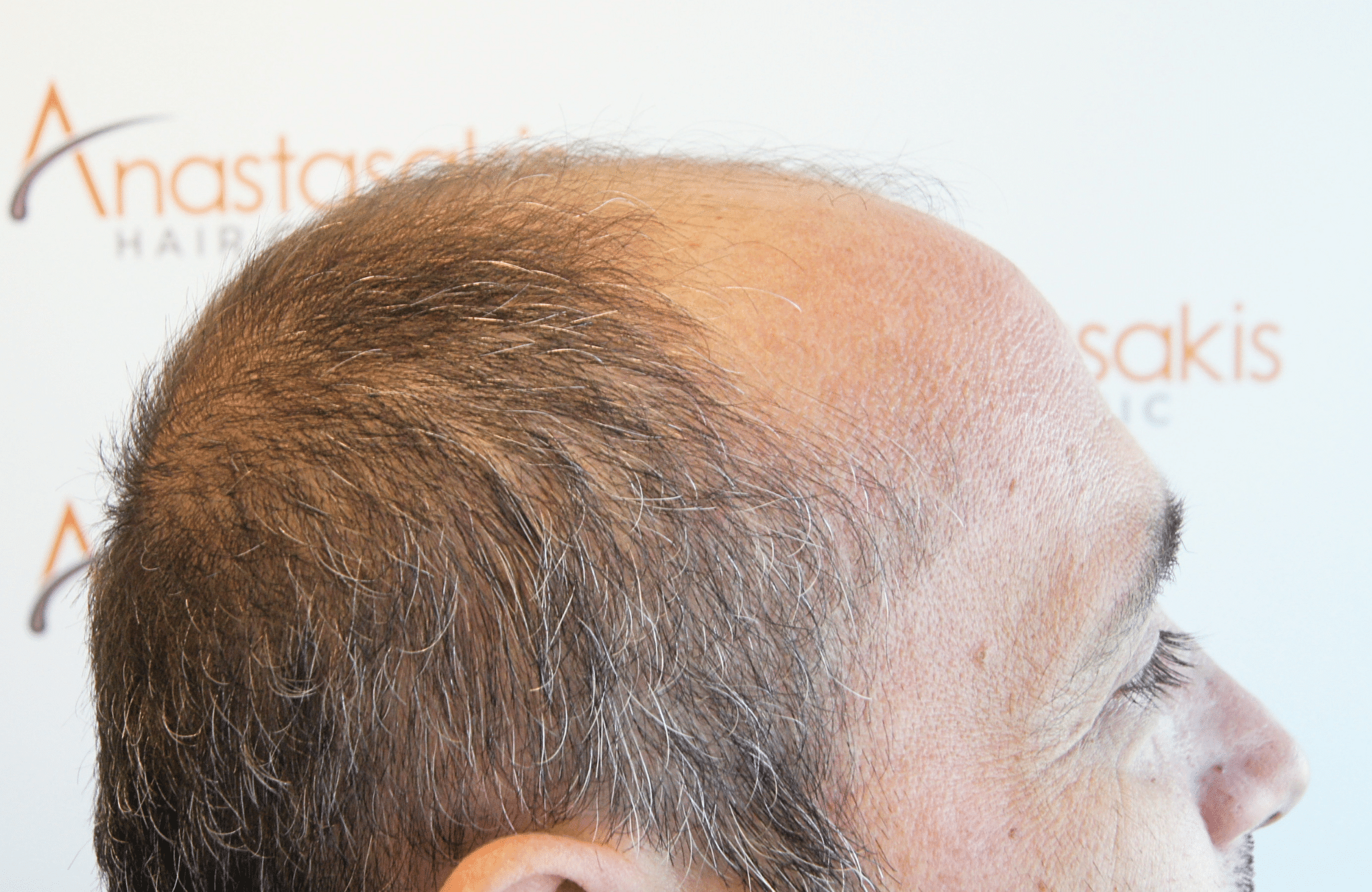 HAIR TRANSPLANT RESULT 3000 FUS STAGE 6 THIN 1ST STAGE