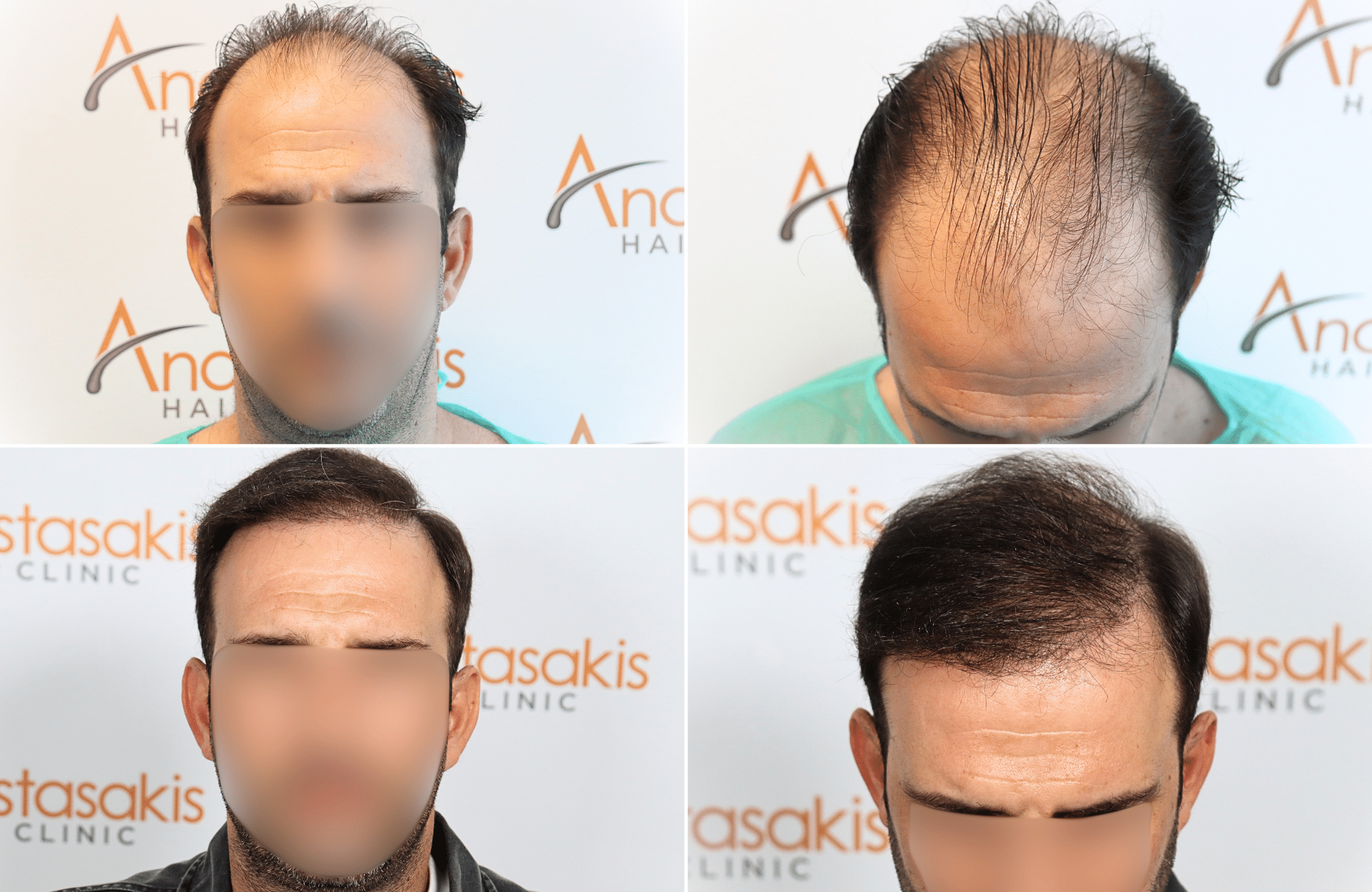 https://www.anastasakishairclinic.gr/portfolio/apotelesma-metamosxefsis-mallion-anastasakis-hair-clinic-603/