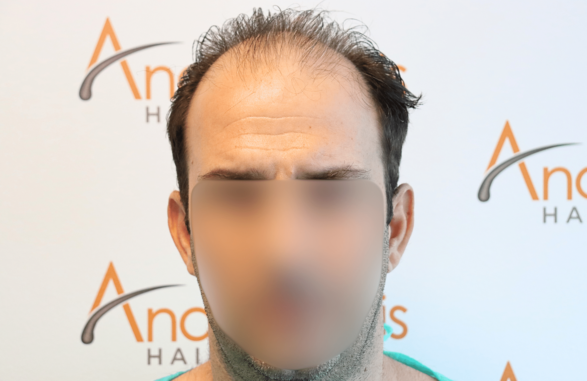hair transplant 2600 fus thin 1st stage